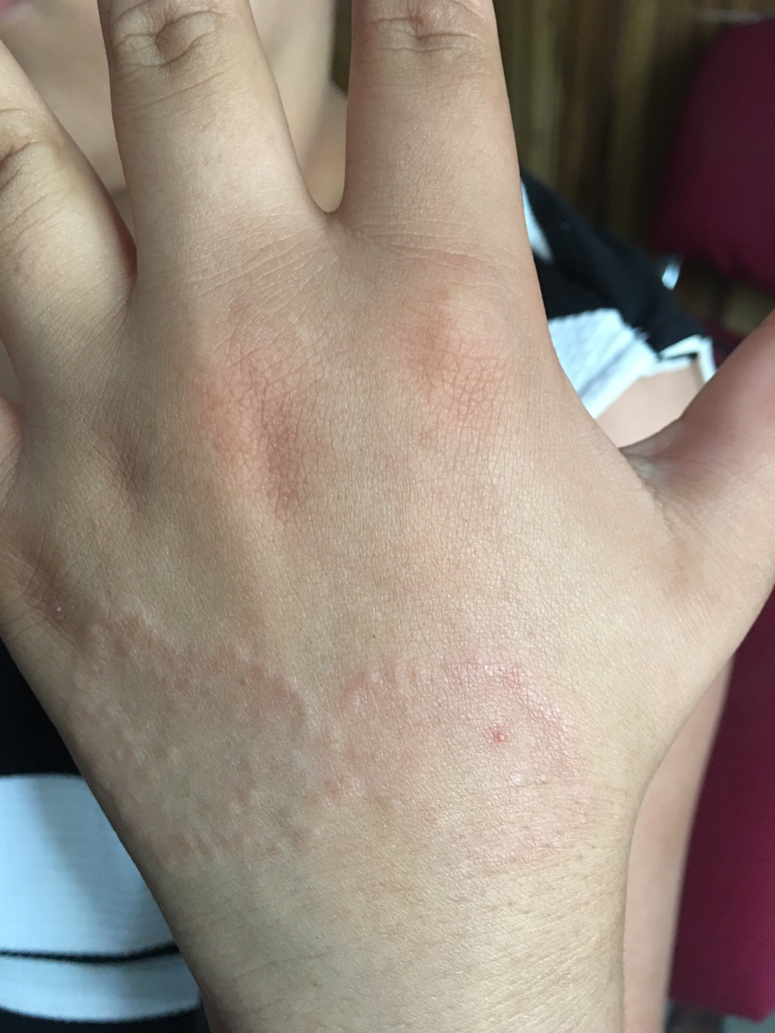 GRANULOMA ANULAR