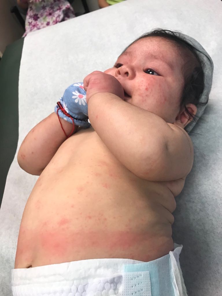 URTICARIA en lactante