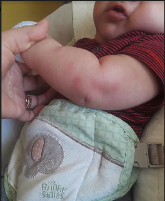 URTICARIA en lactante