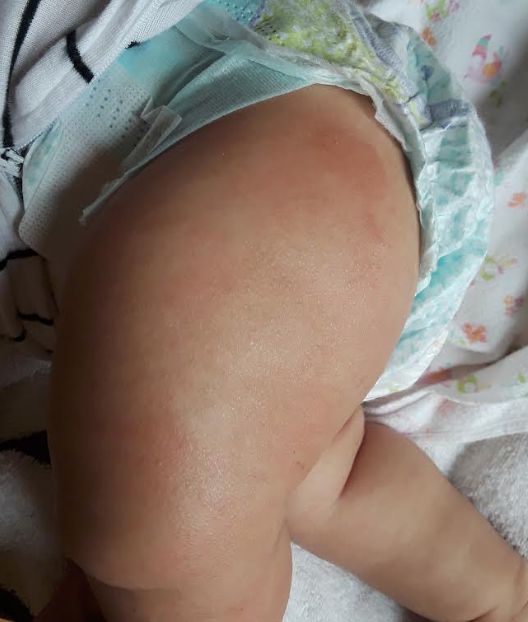 URTICARIA en lactante