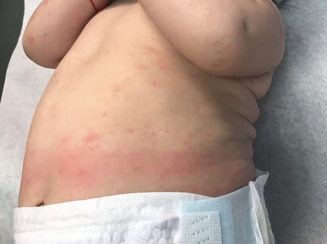 URTICARIA en lactante