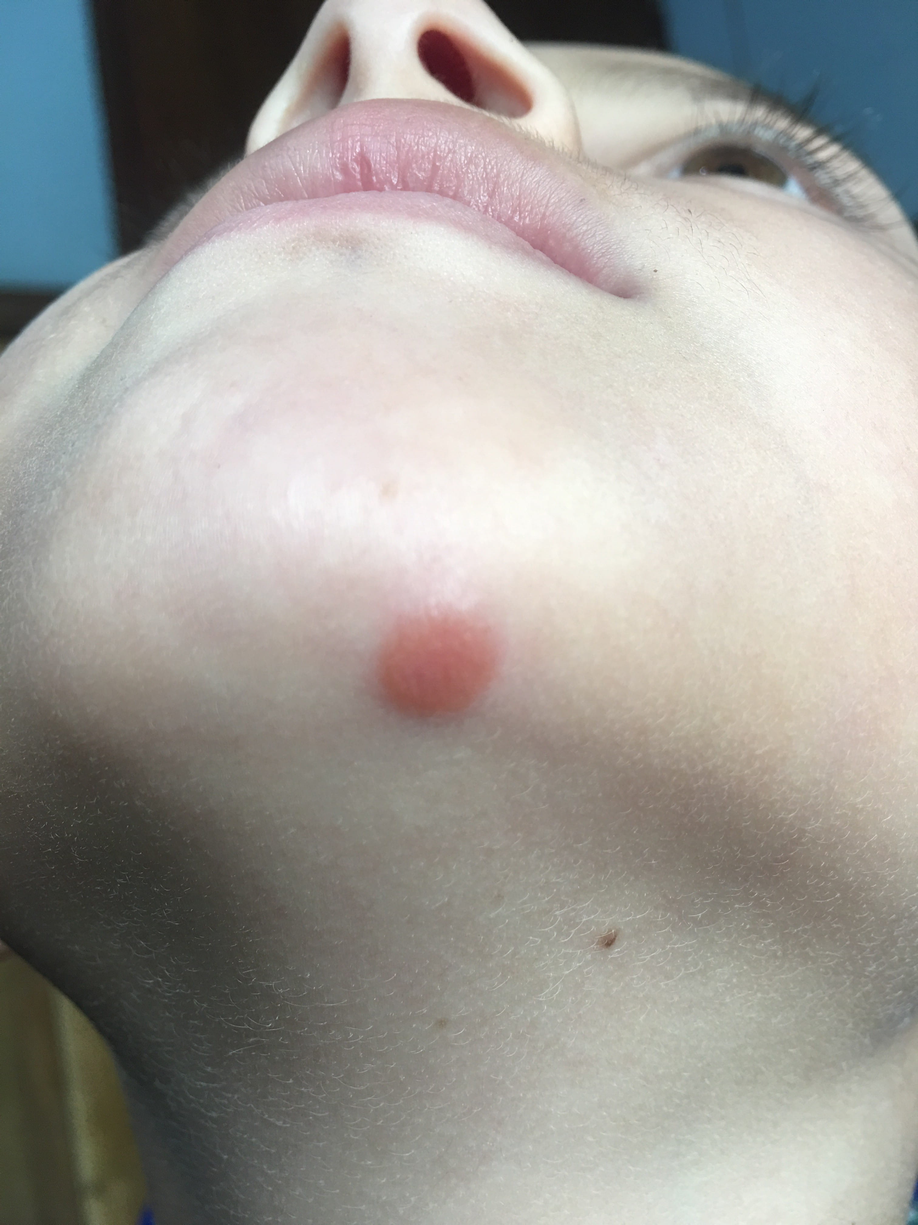 XANTOGRANULOMA INFANTIL