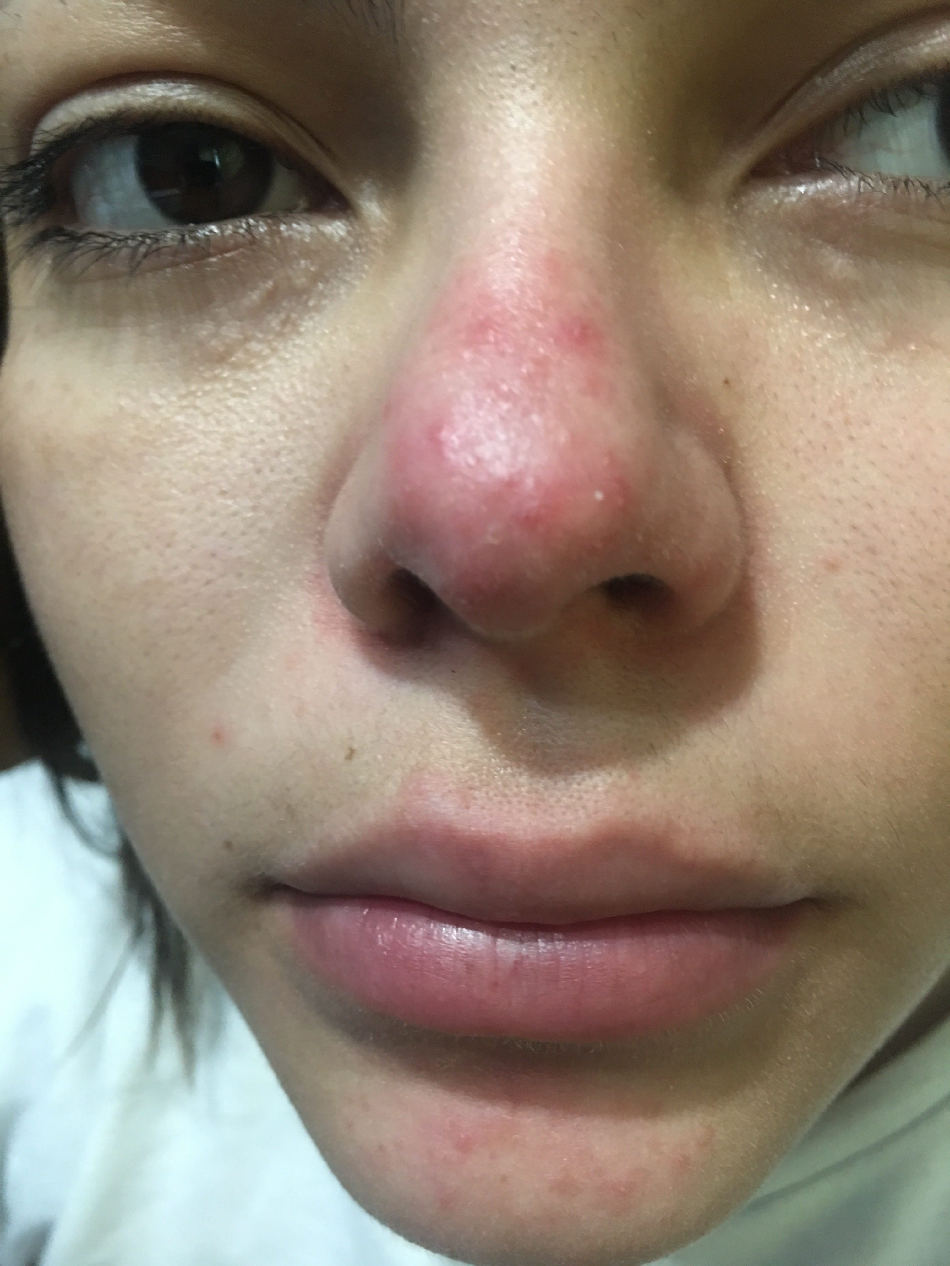 ROSACEA