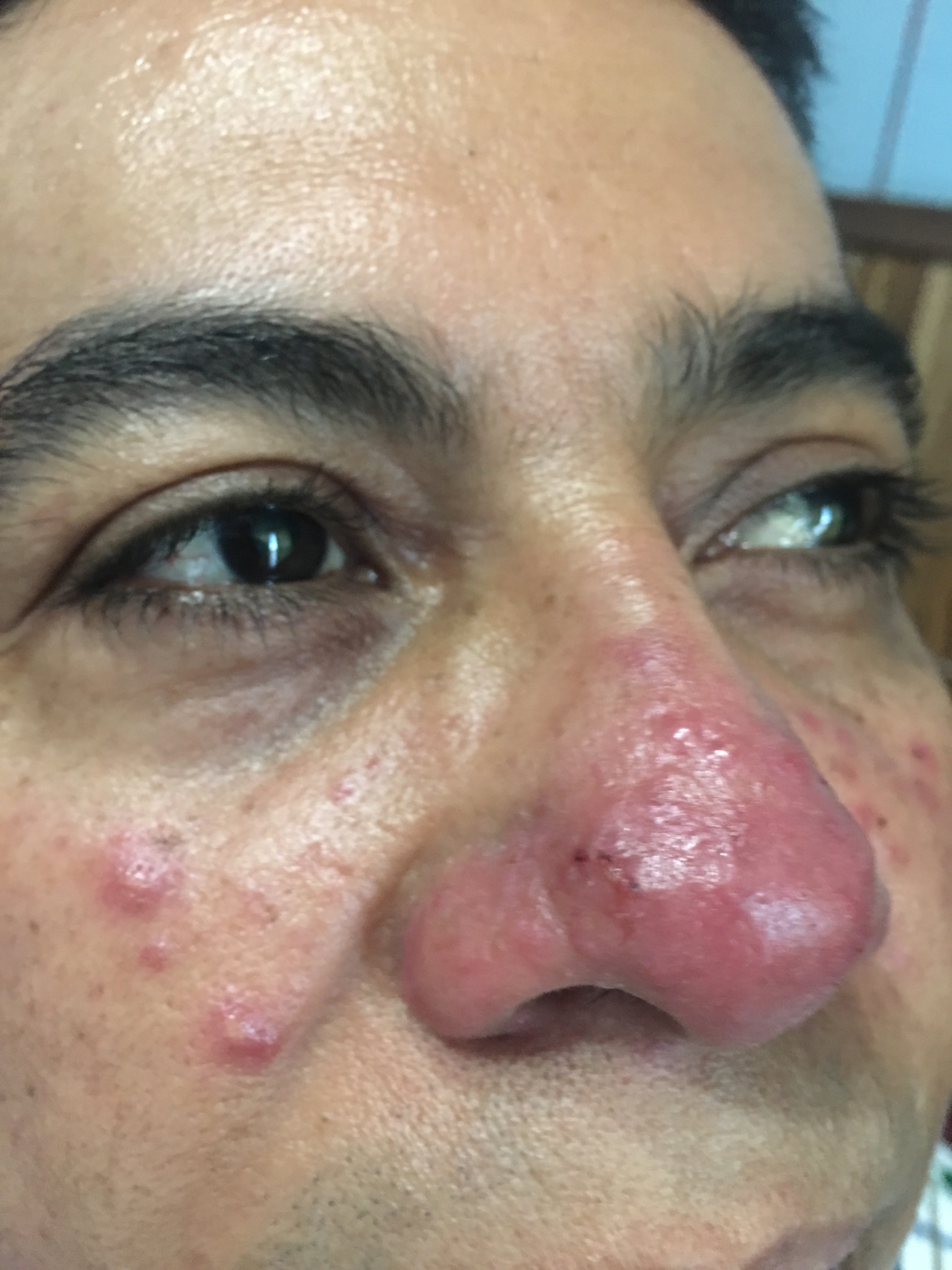 ROSACEA