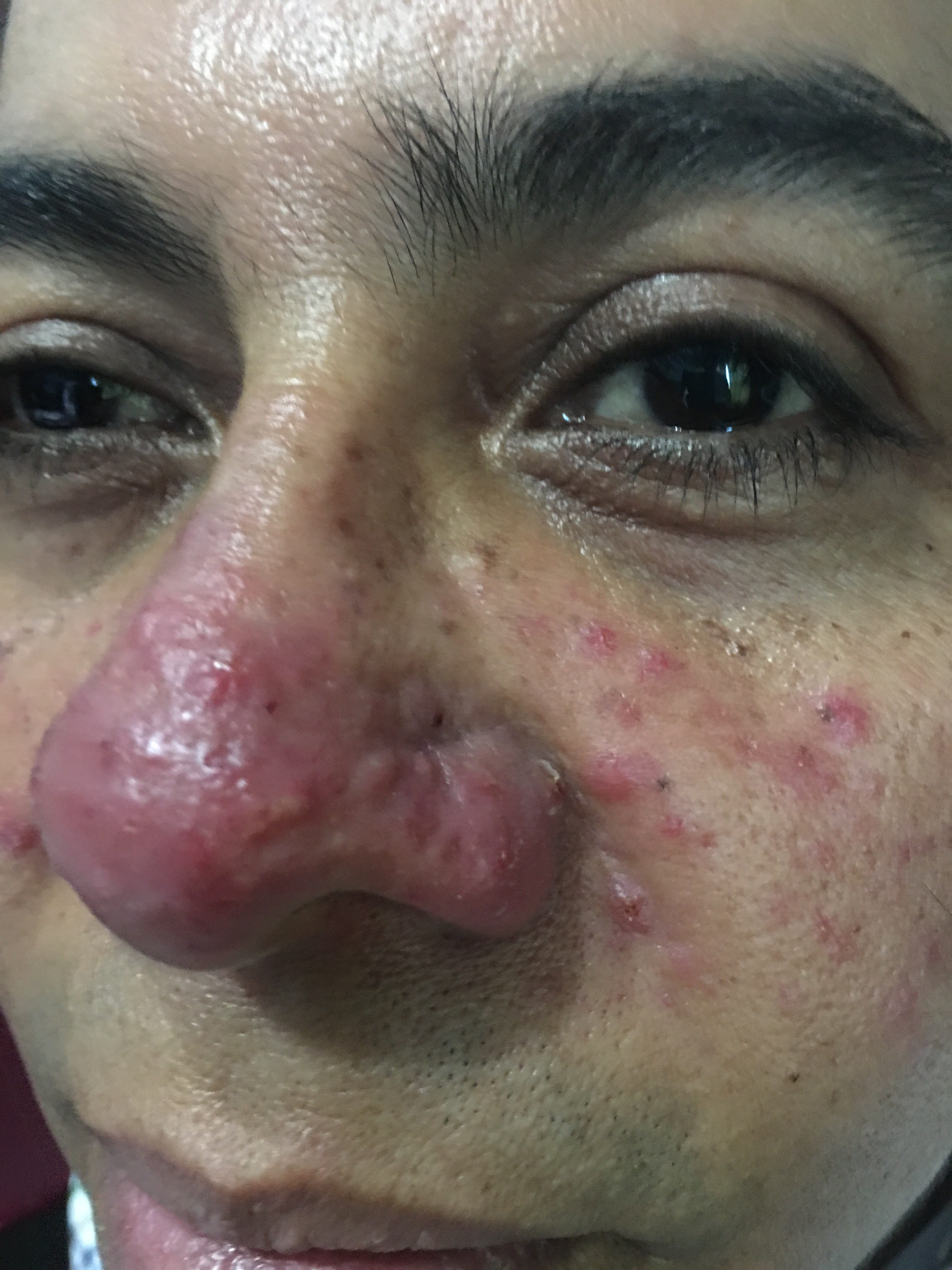 ROSACEA