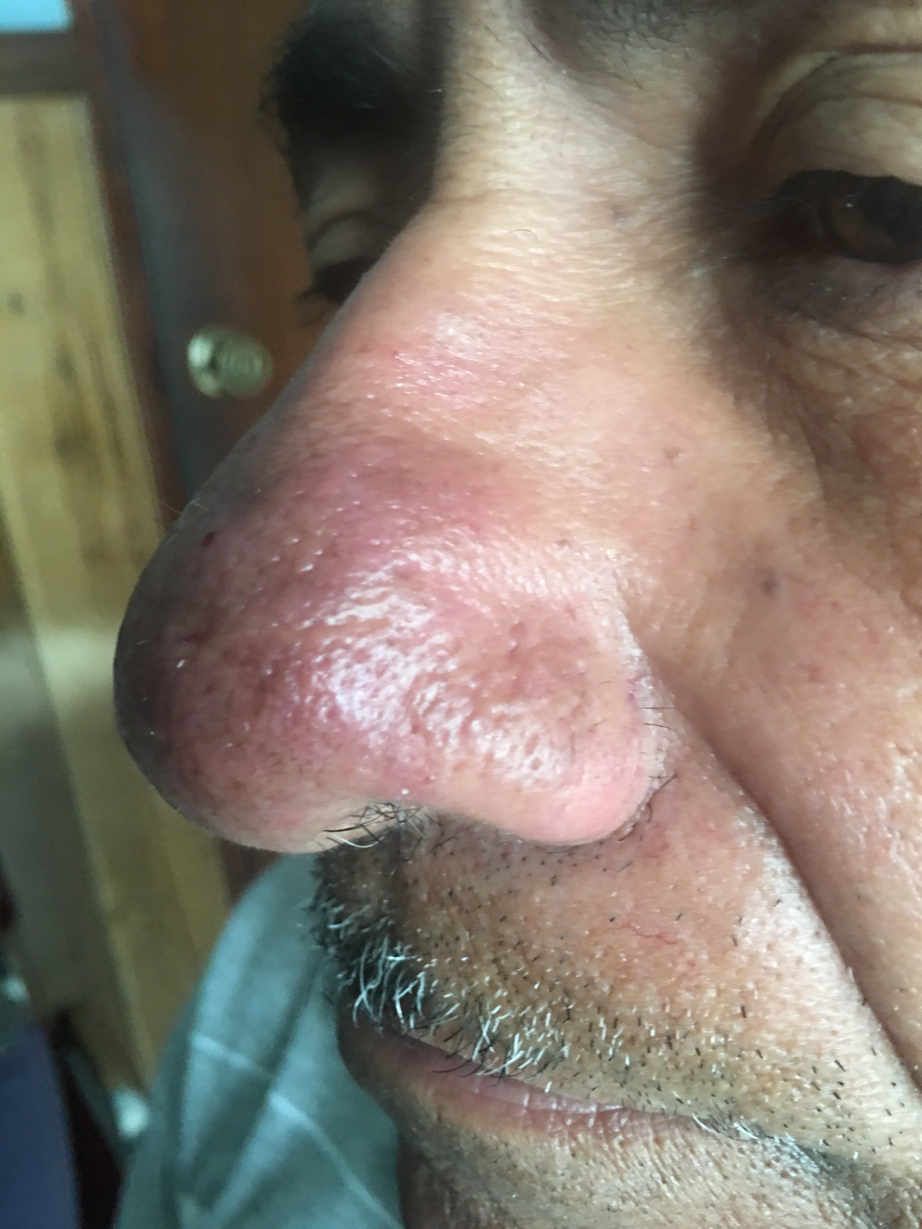 ROSACEA
