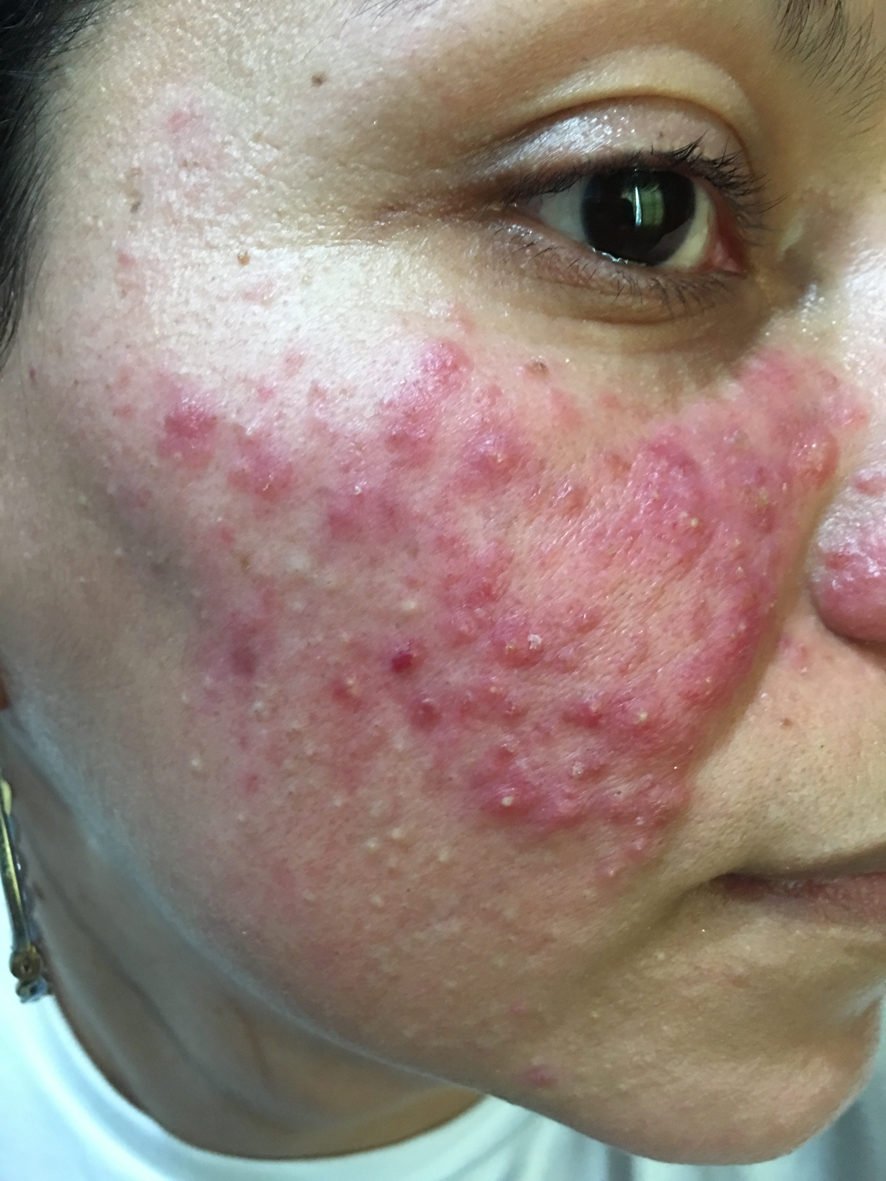 ROSACEA