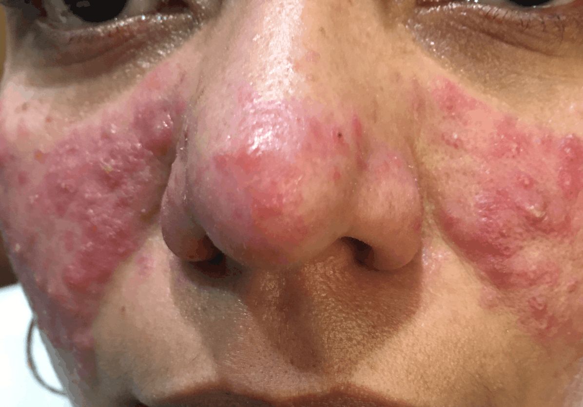 ROSACEA