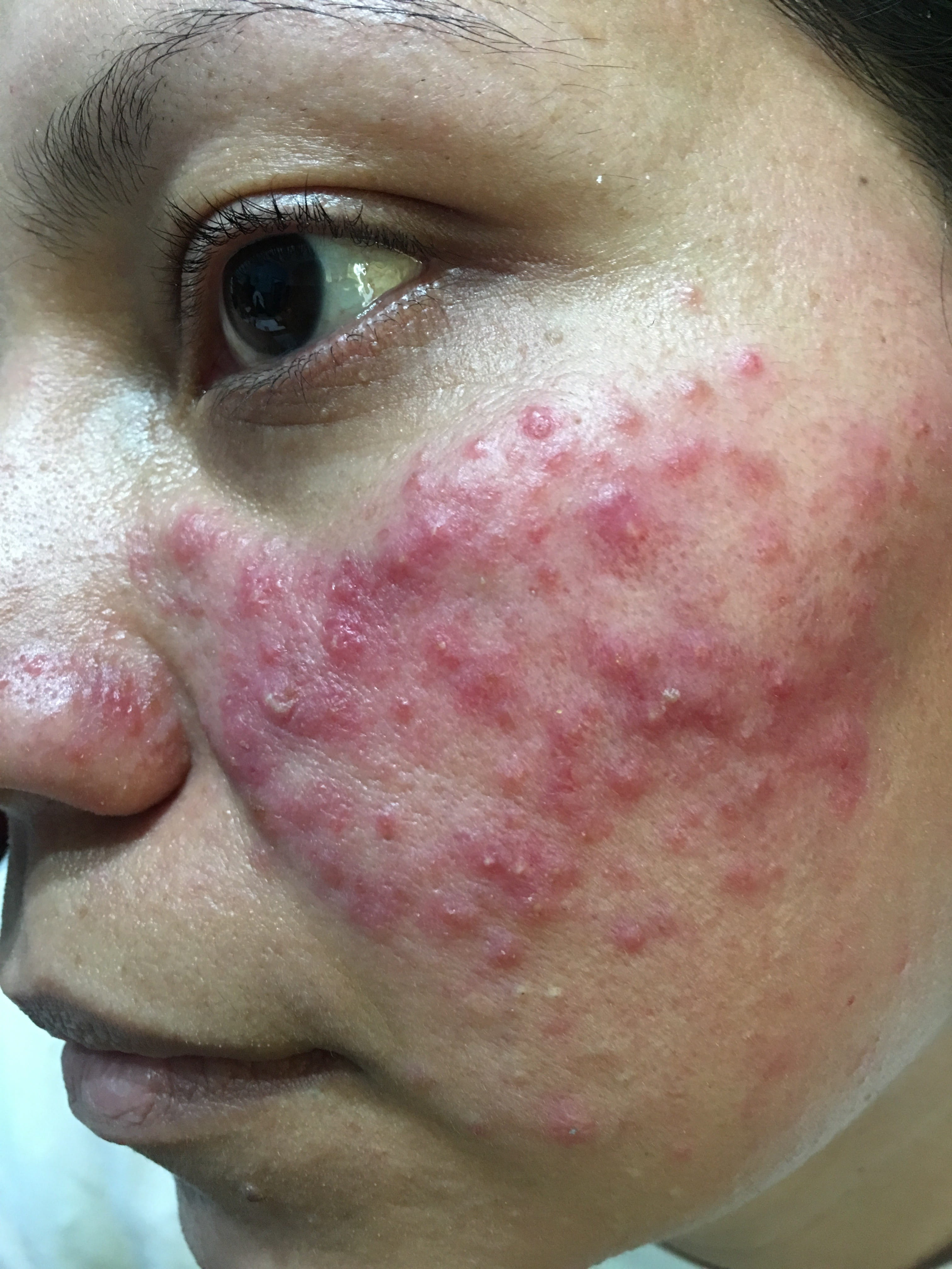 ROSACEA