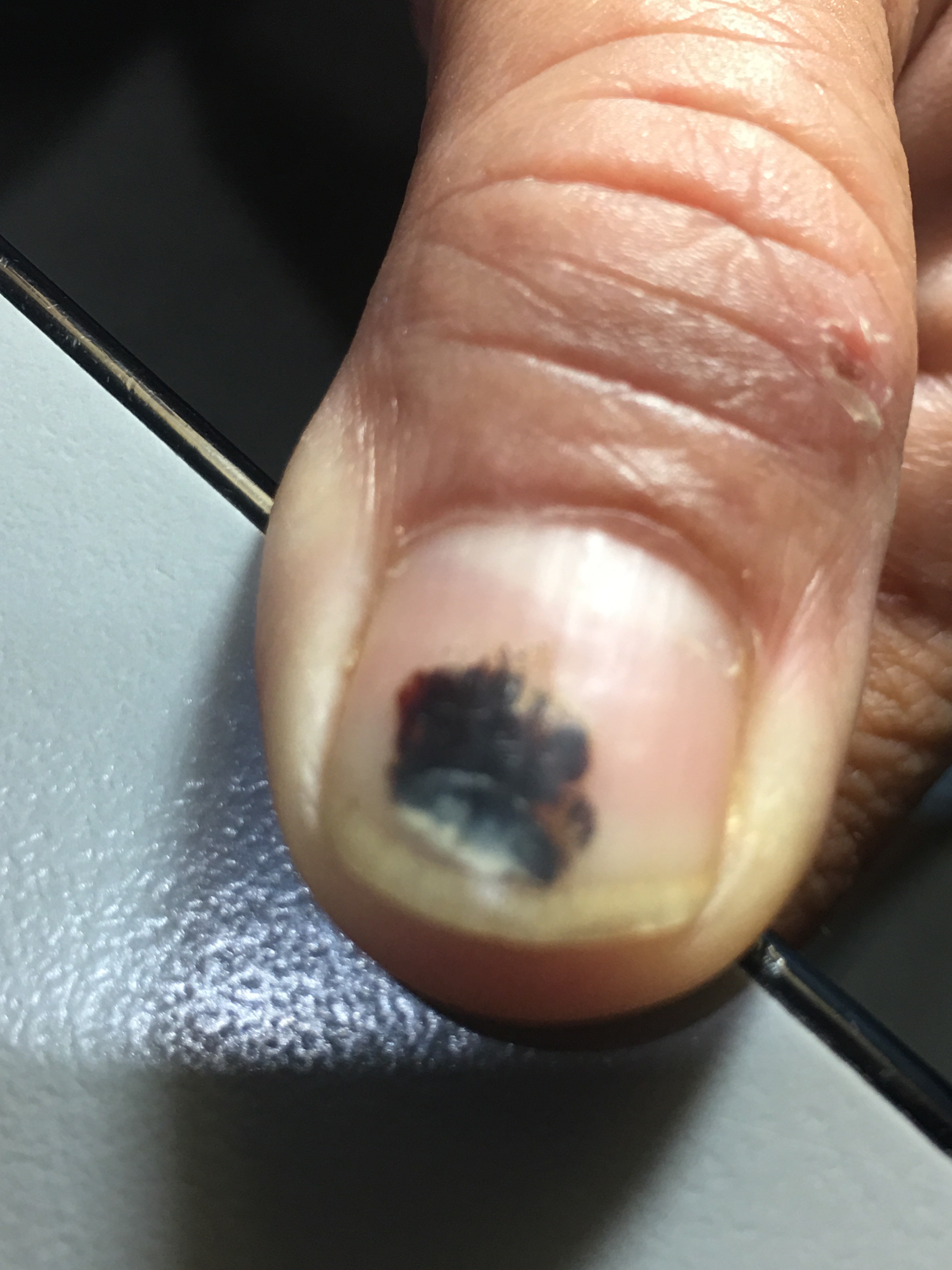 HEMATOMA SUBUNGUEAL