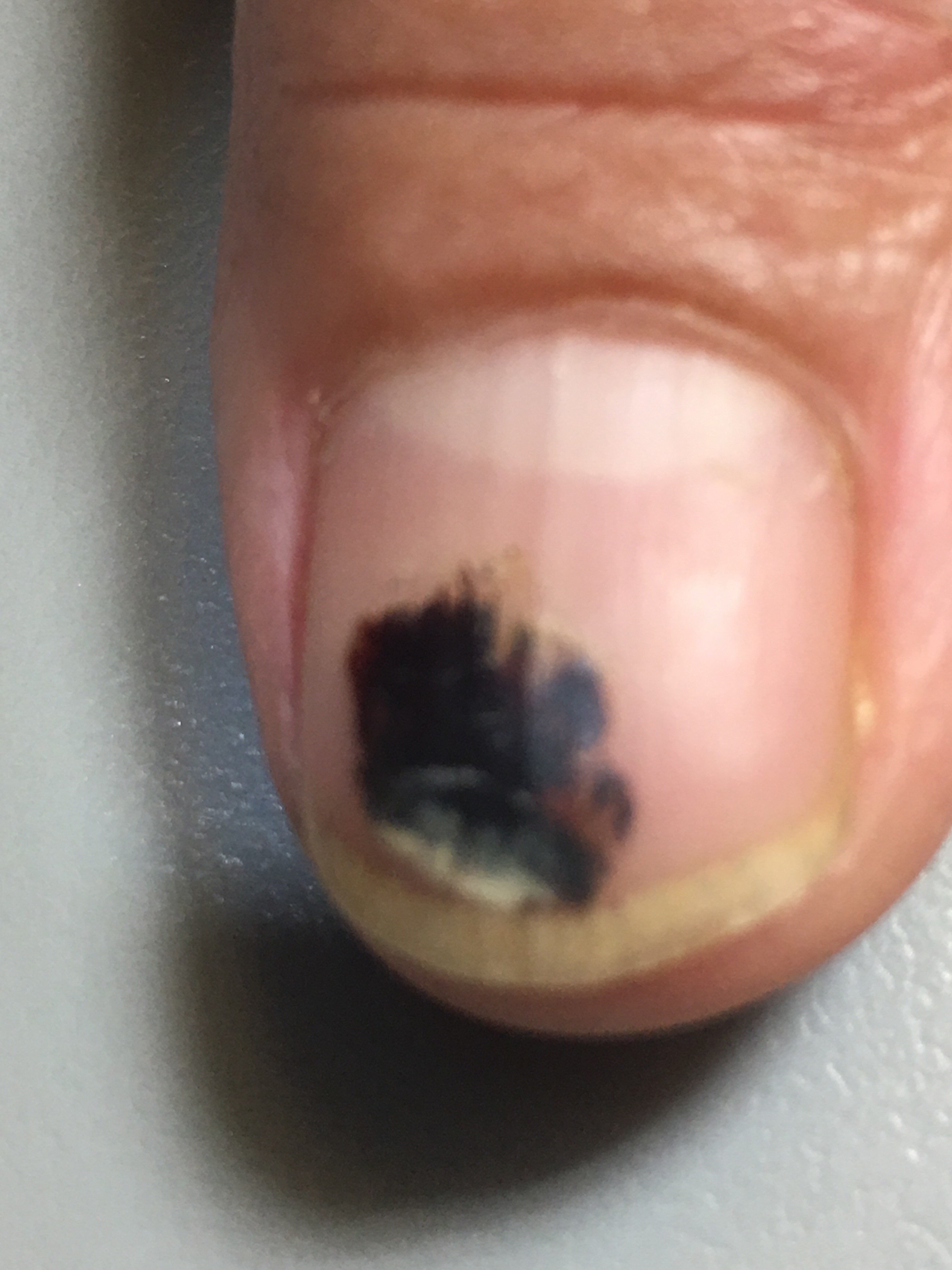 HEMATOMA SUBUNGUEAL