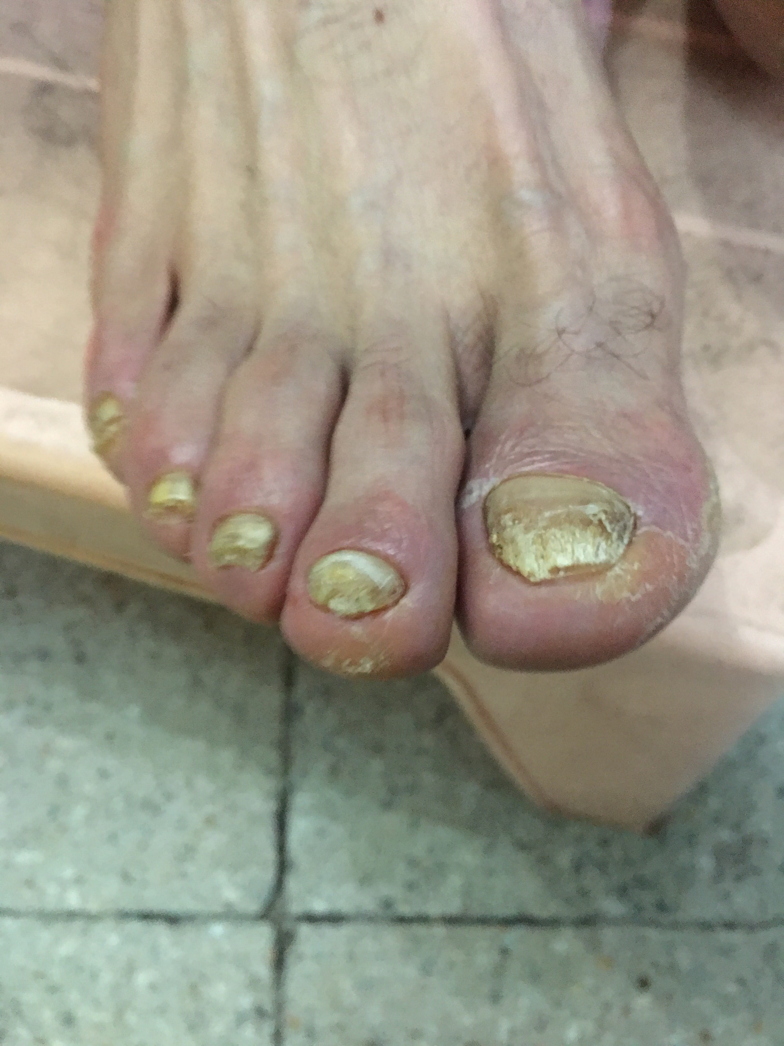 TIÑA DE LAS UÑAS