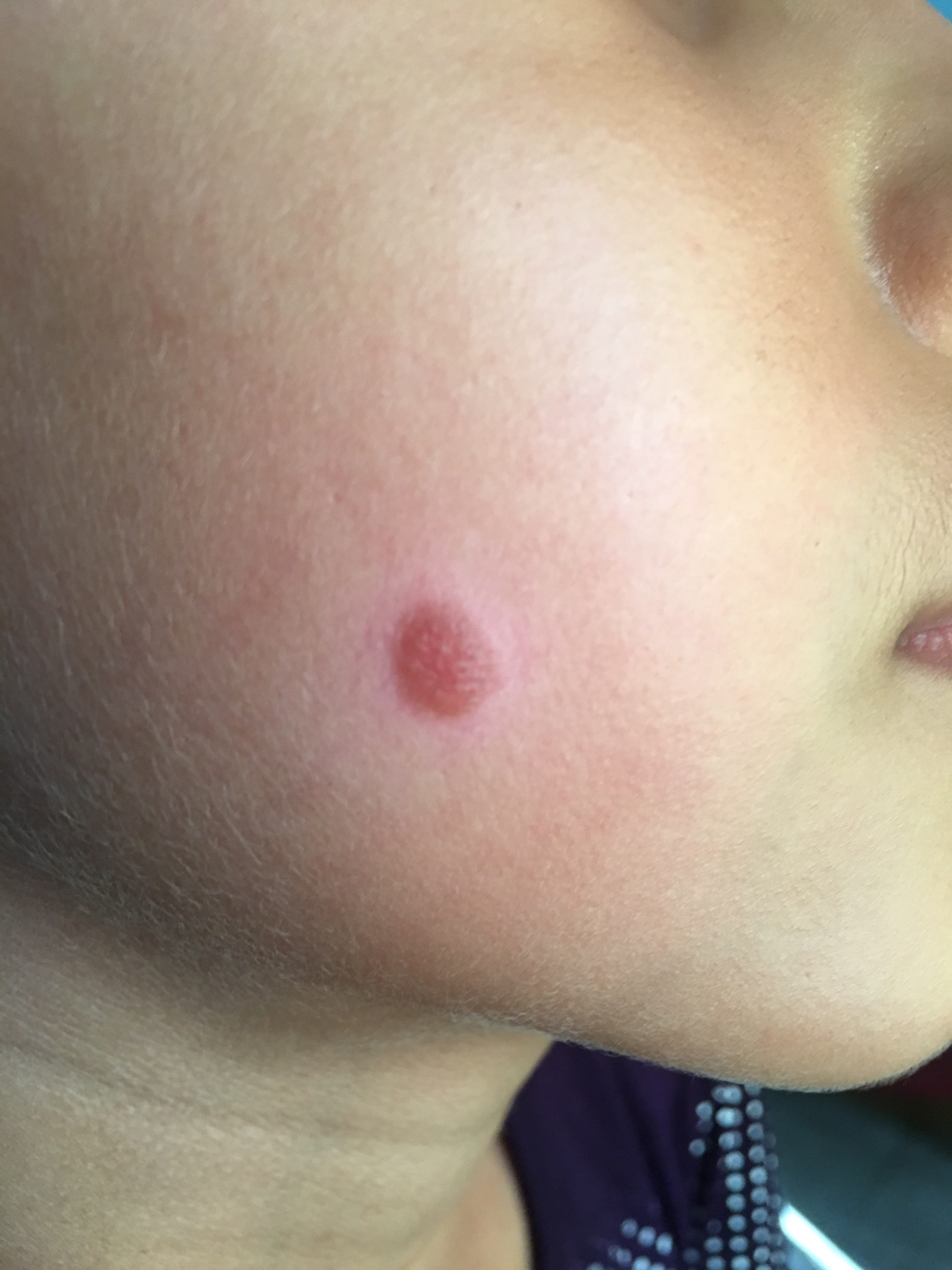 XANTOGRANULOMA INFANTIL