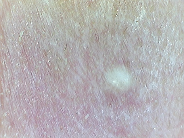 QUISTE DE INCLUSION EPIDERMICA