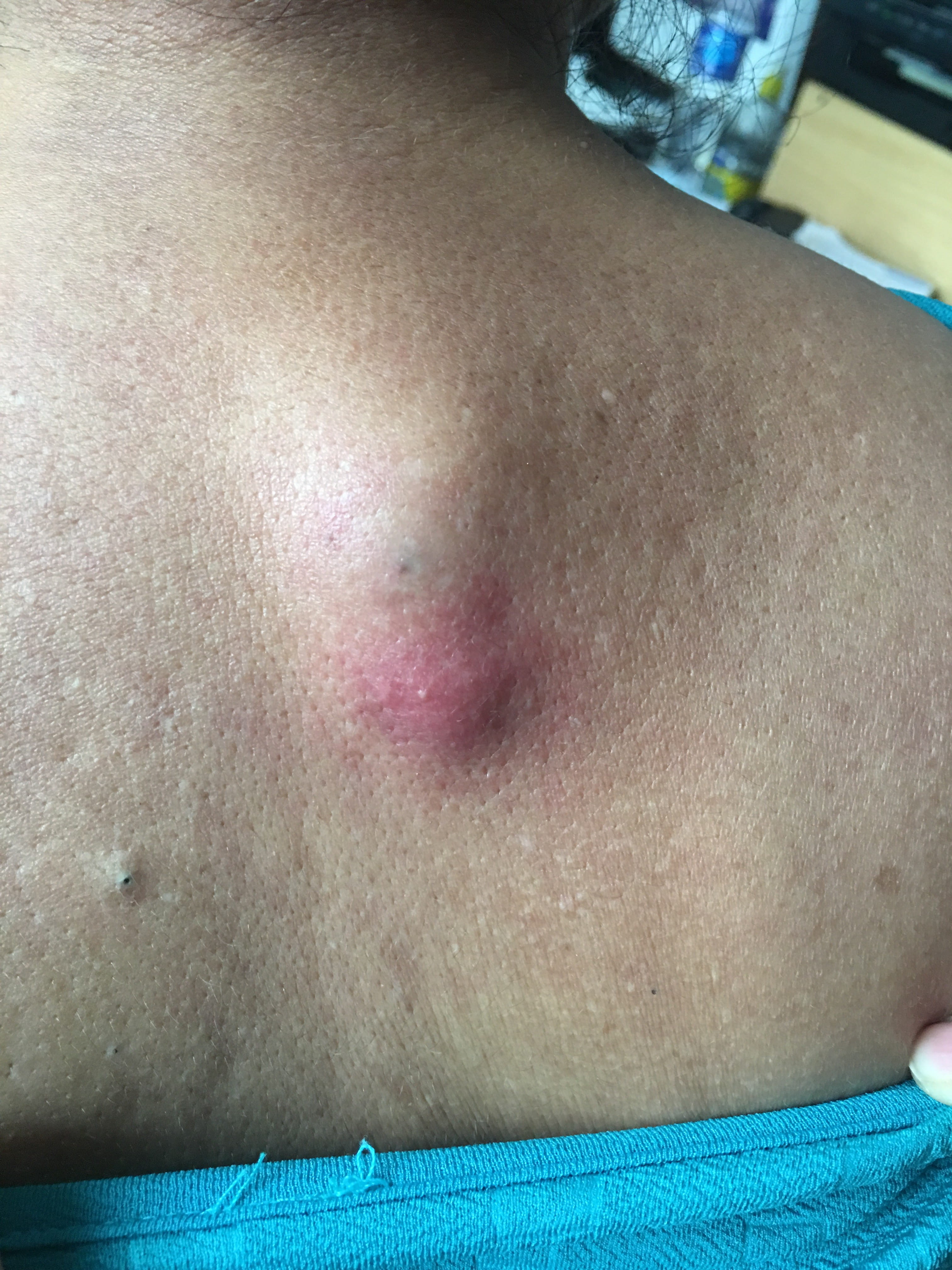 QUISTE DE INCLUSION EPIDERMICA  Infectado