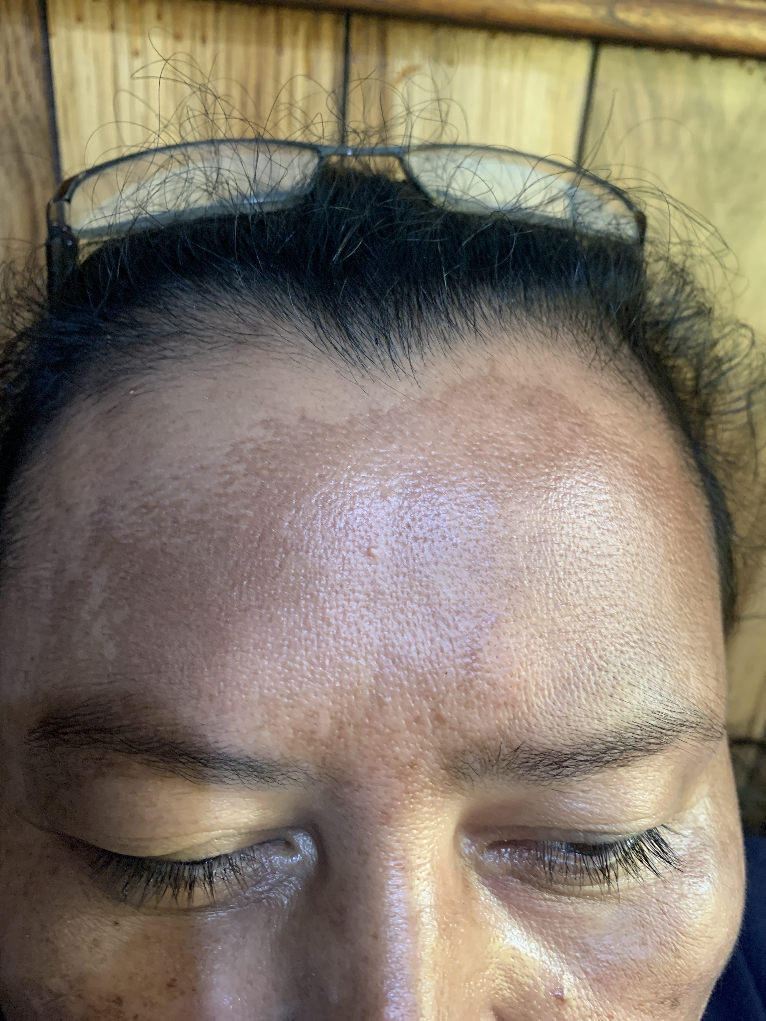 MELASMA