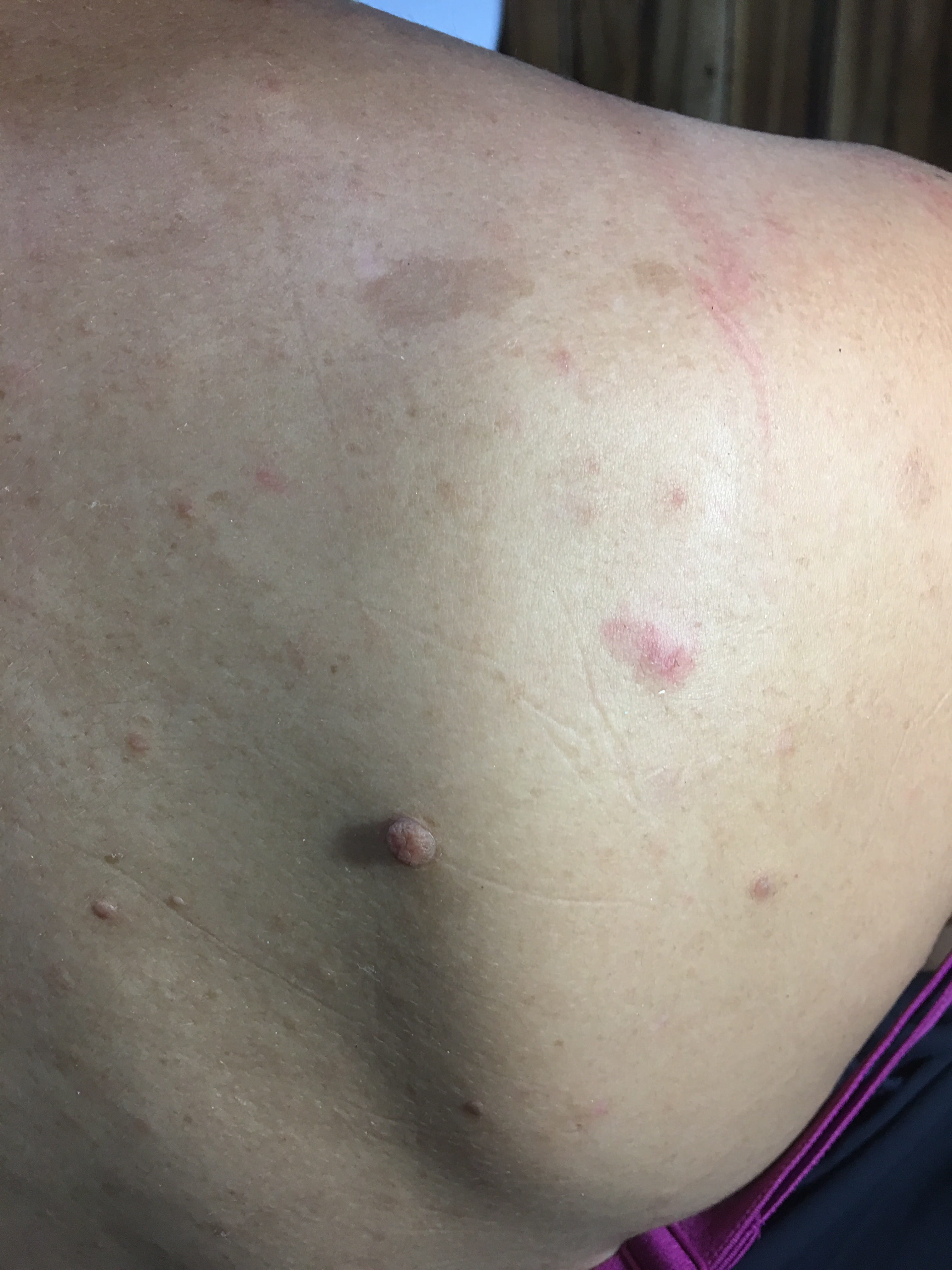 NEUROFIBROMATOSIS MULTIPLE - MANCHAS CAFE CON LECHE