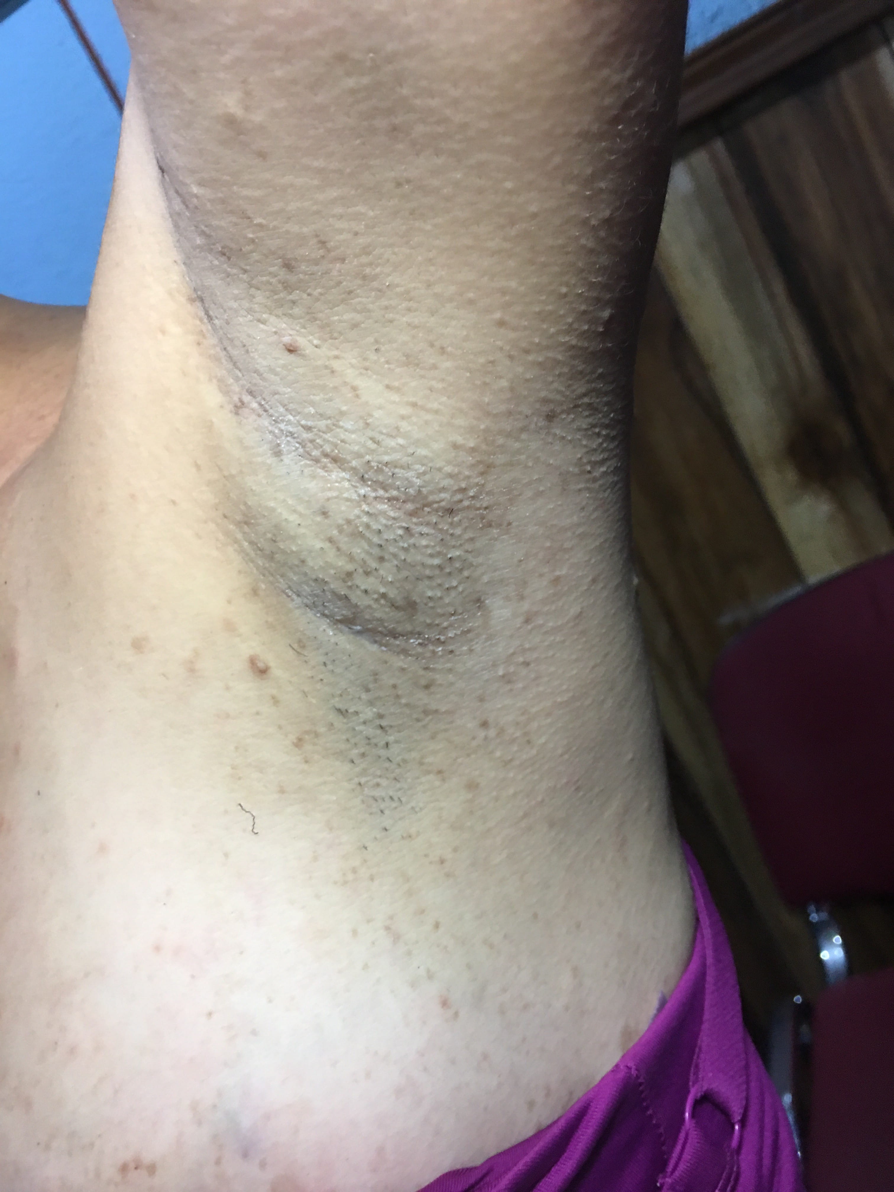 NEUROFIBROMATOSIS MULTIPLE
