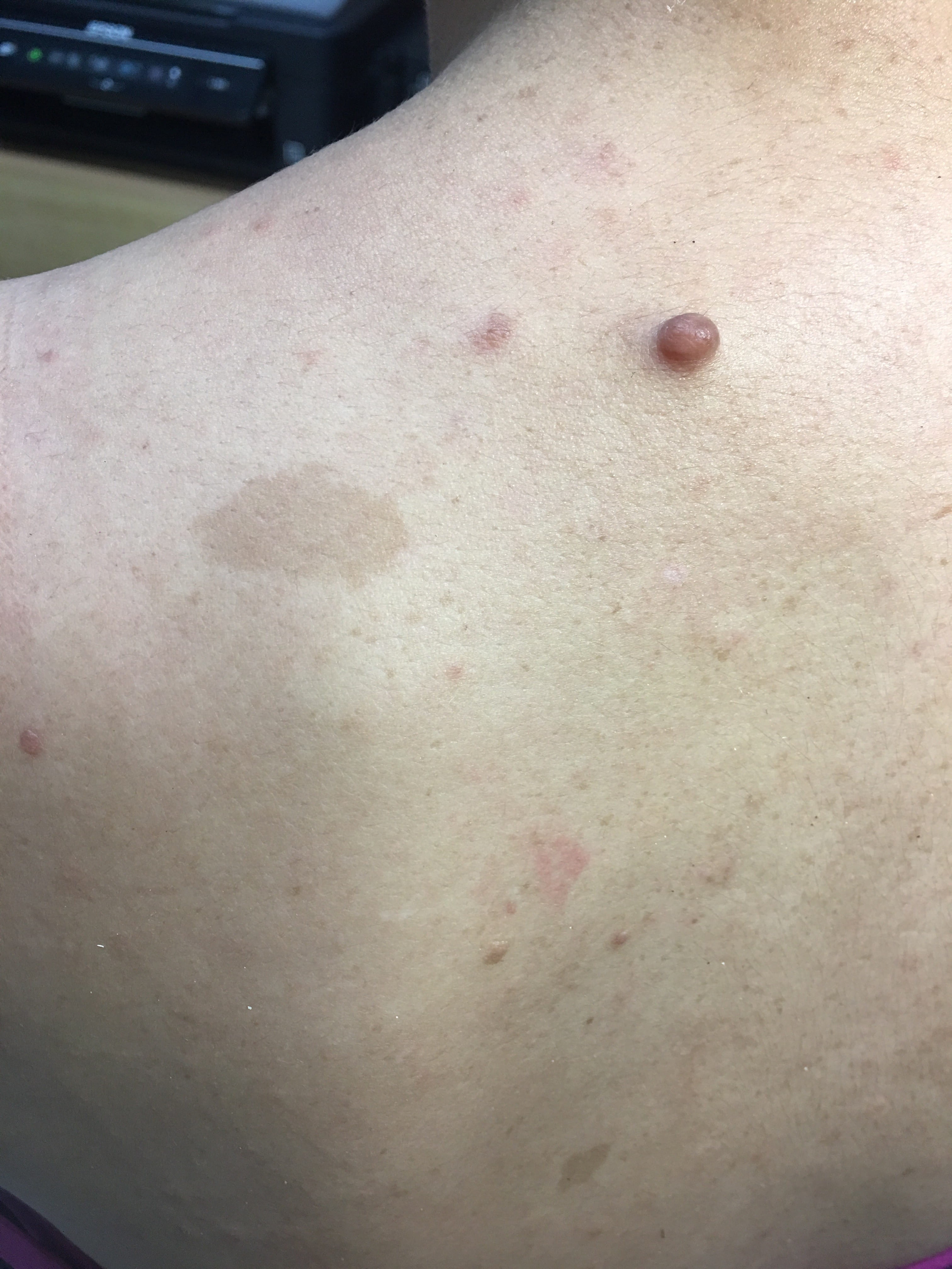 NEUROFIBROMATOSIS MULTIPLE - MANCHAS CAFE CON LECHE