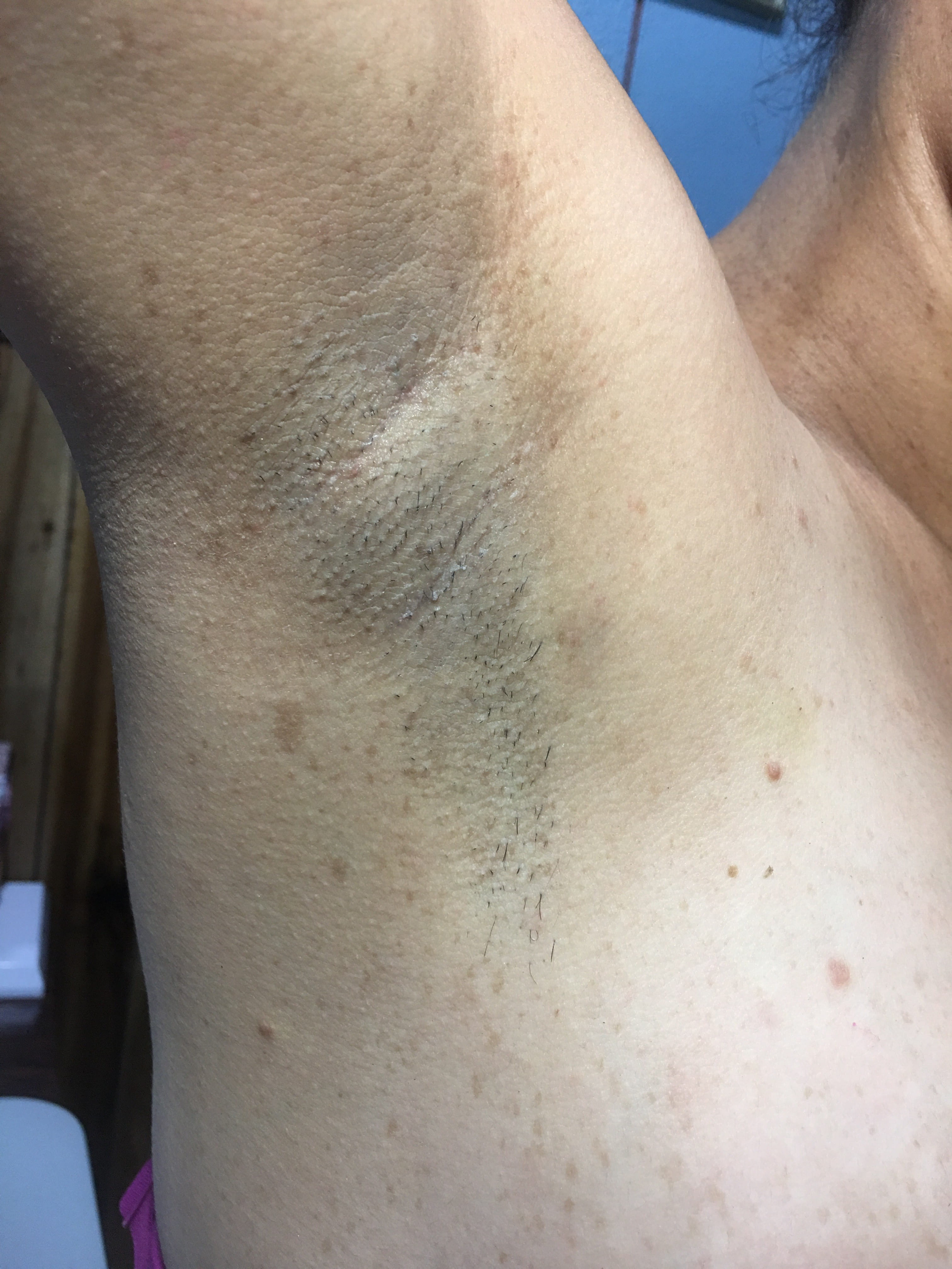 NEUROFIBROMATOSIS MULTIPLE