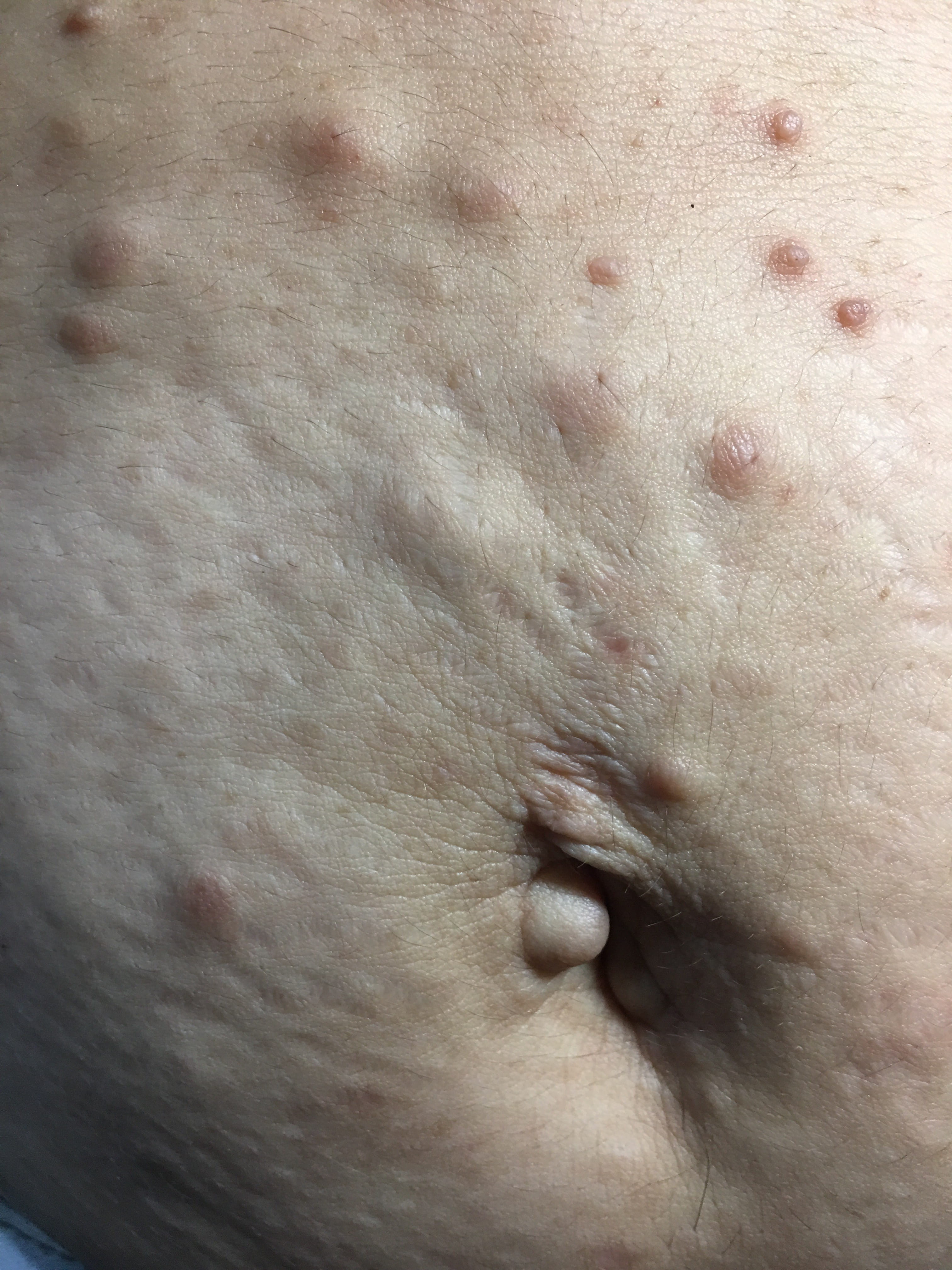 NEUROFIBROMATOSIS MULTIPLE - Neurofibromas