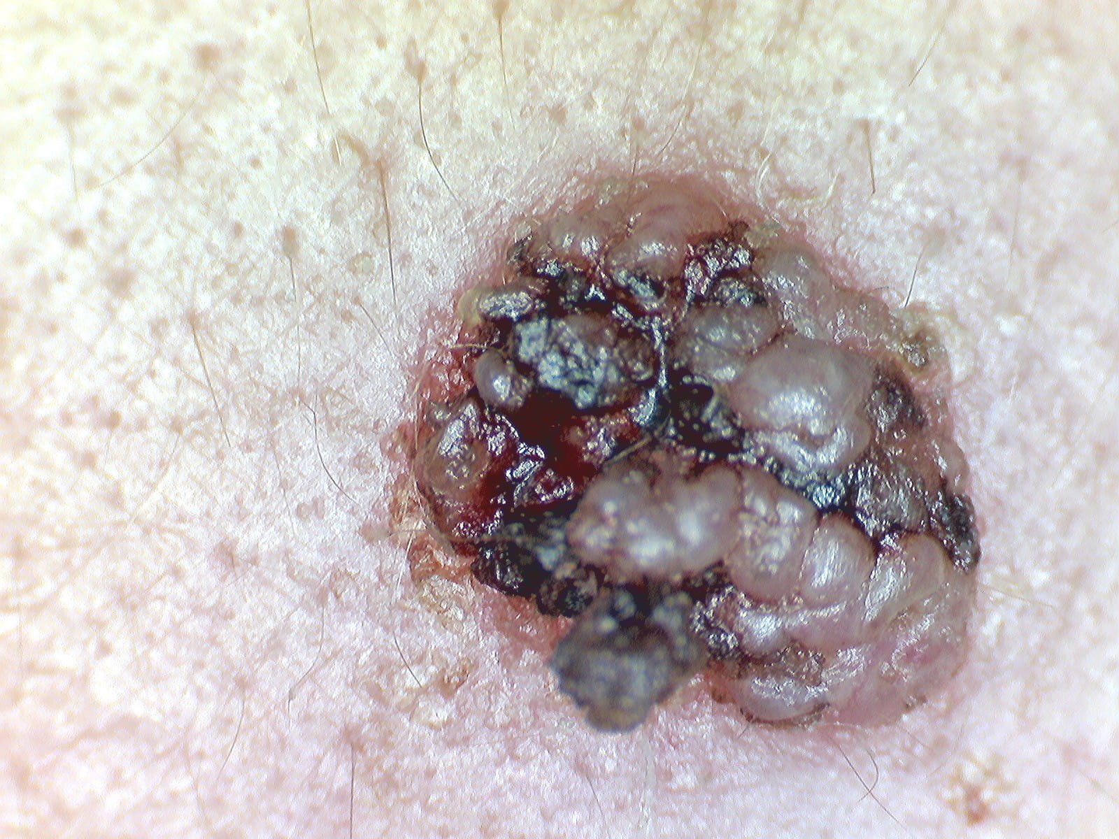 QUERATOSIS SEBORREICA