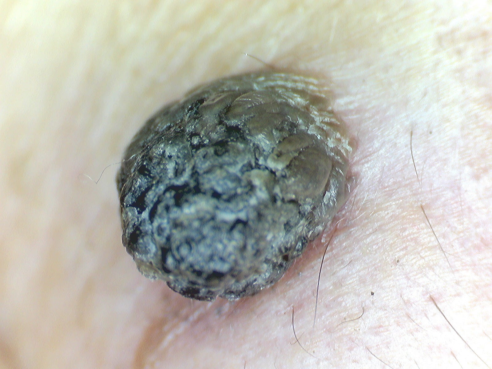 QUERATOSIS SEBORREICA