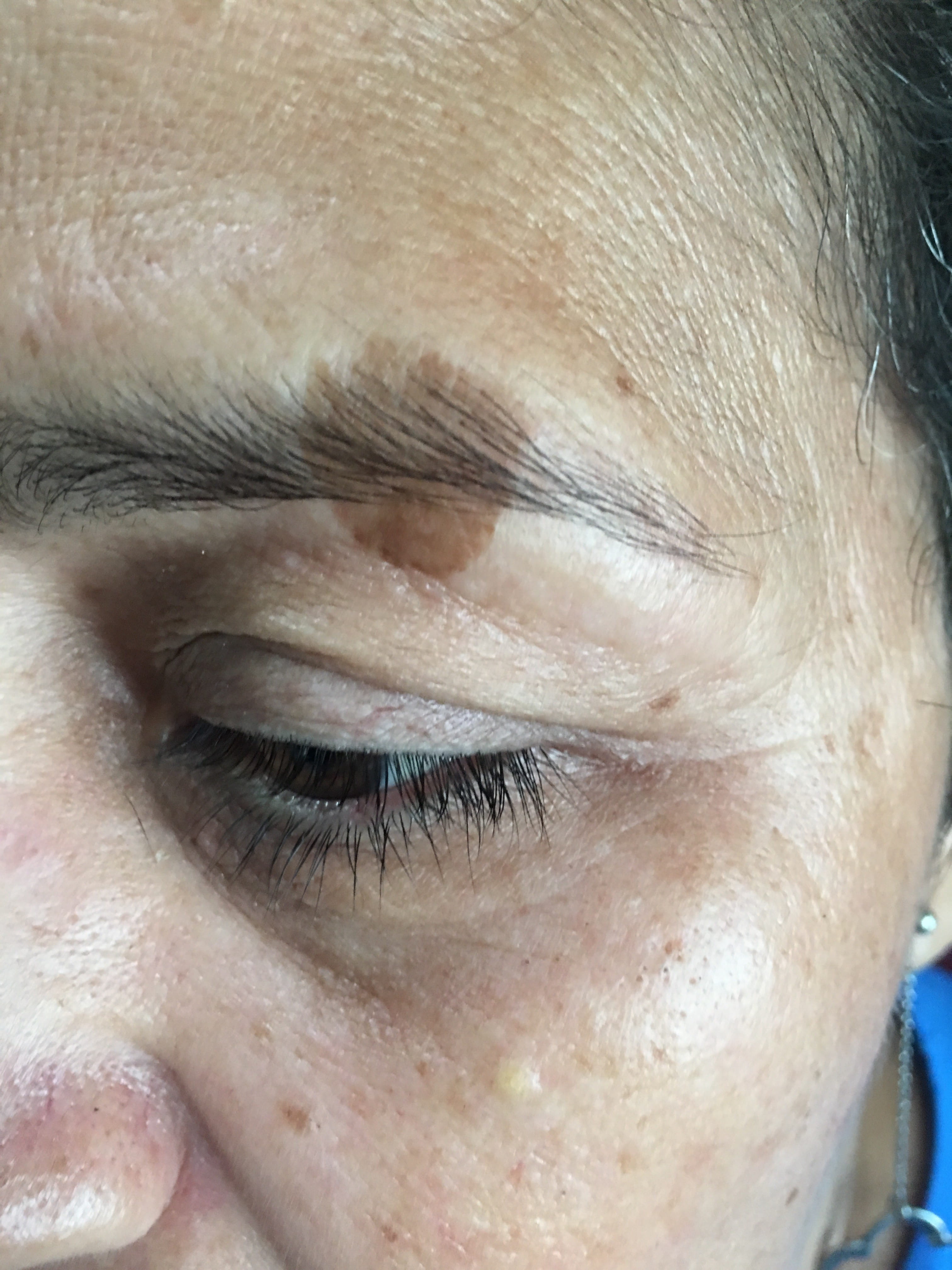 QUERATOSIS SEBORREICA