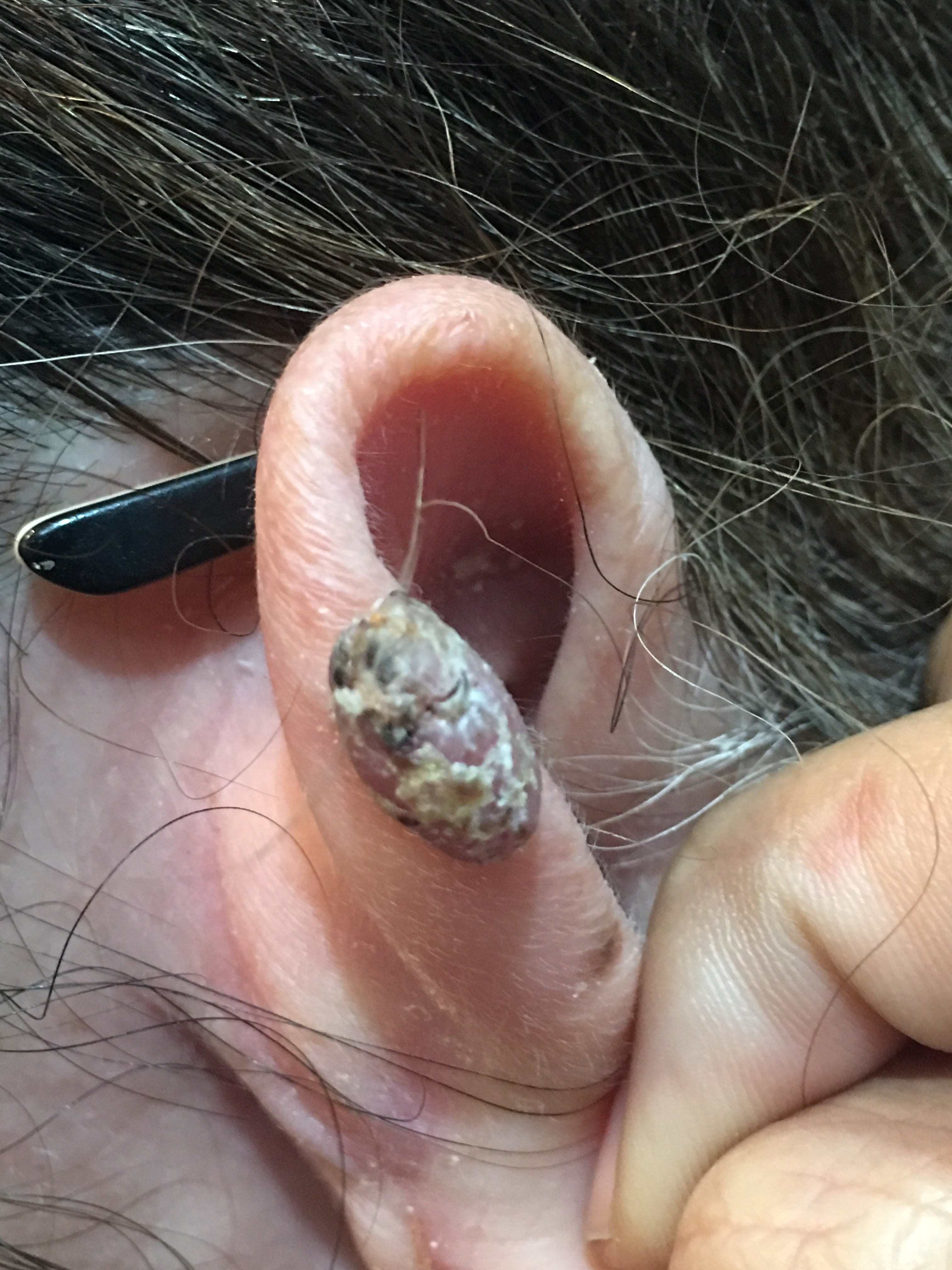 QUERATOSIS SEBORREICA