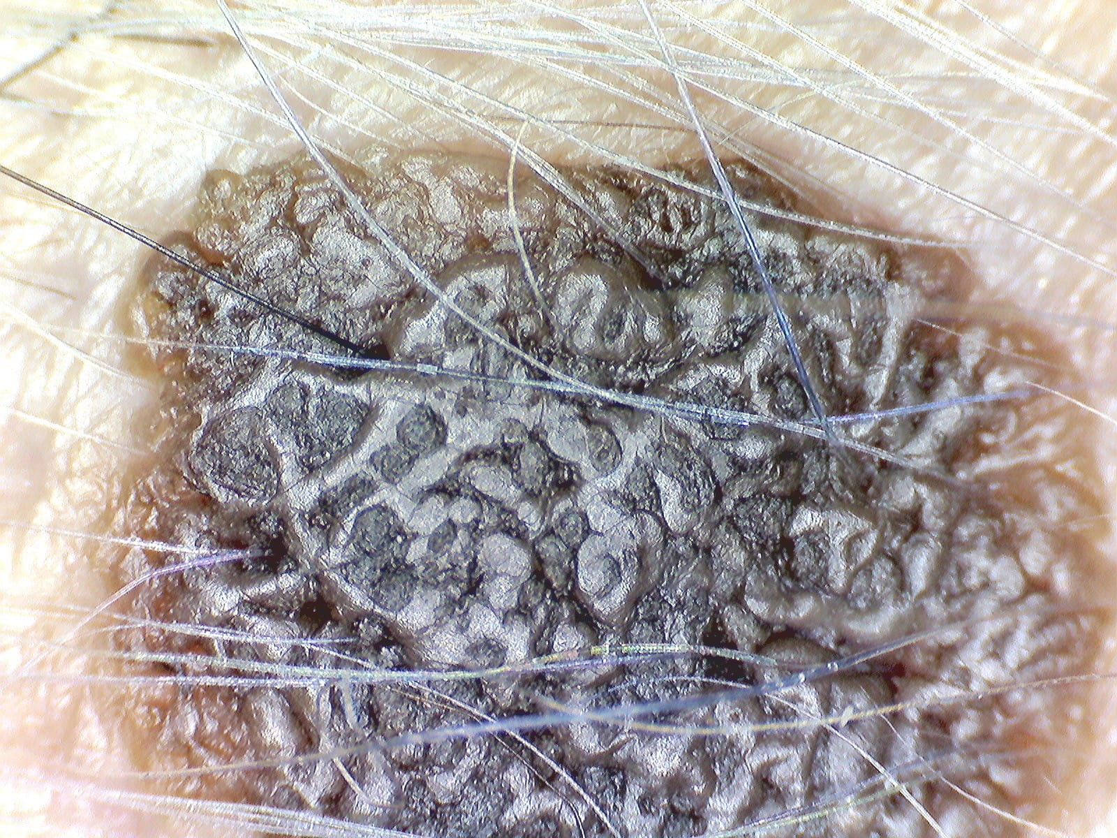 QUERATOSIS SEBORREICA