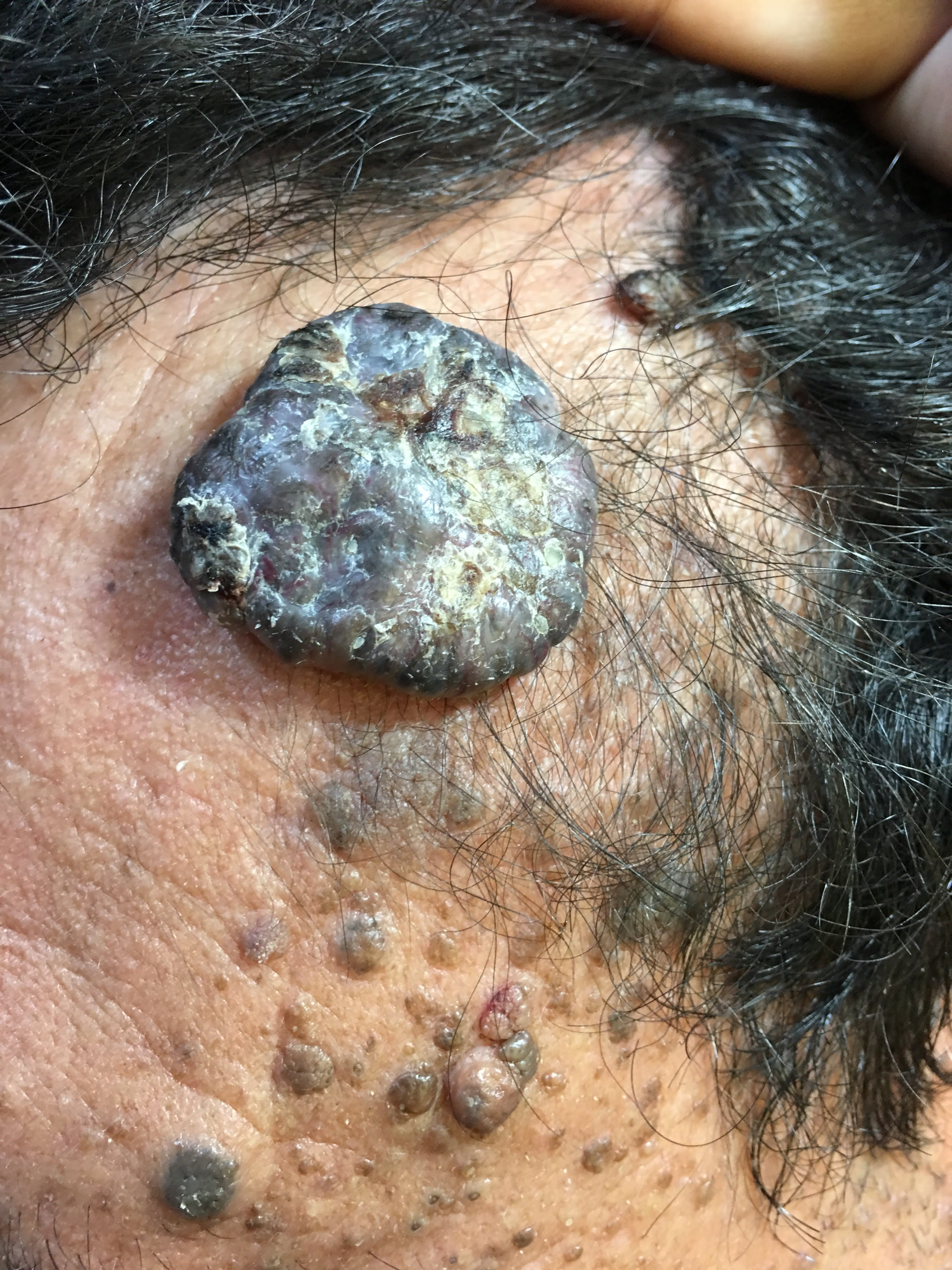 QUERATOSIS SEBORREICA