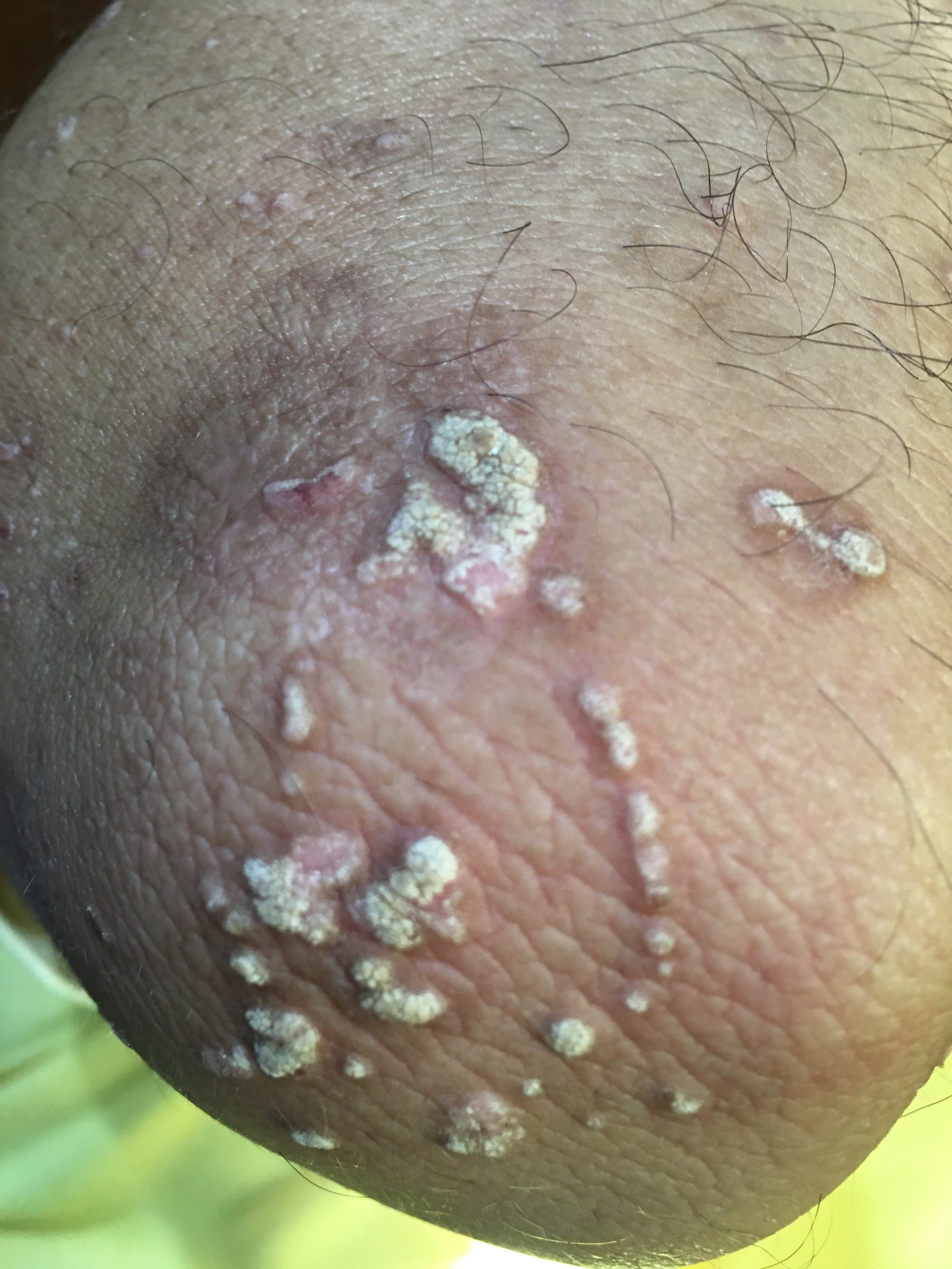 PSORIASIS
