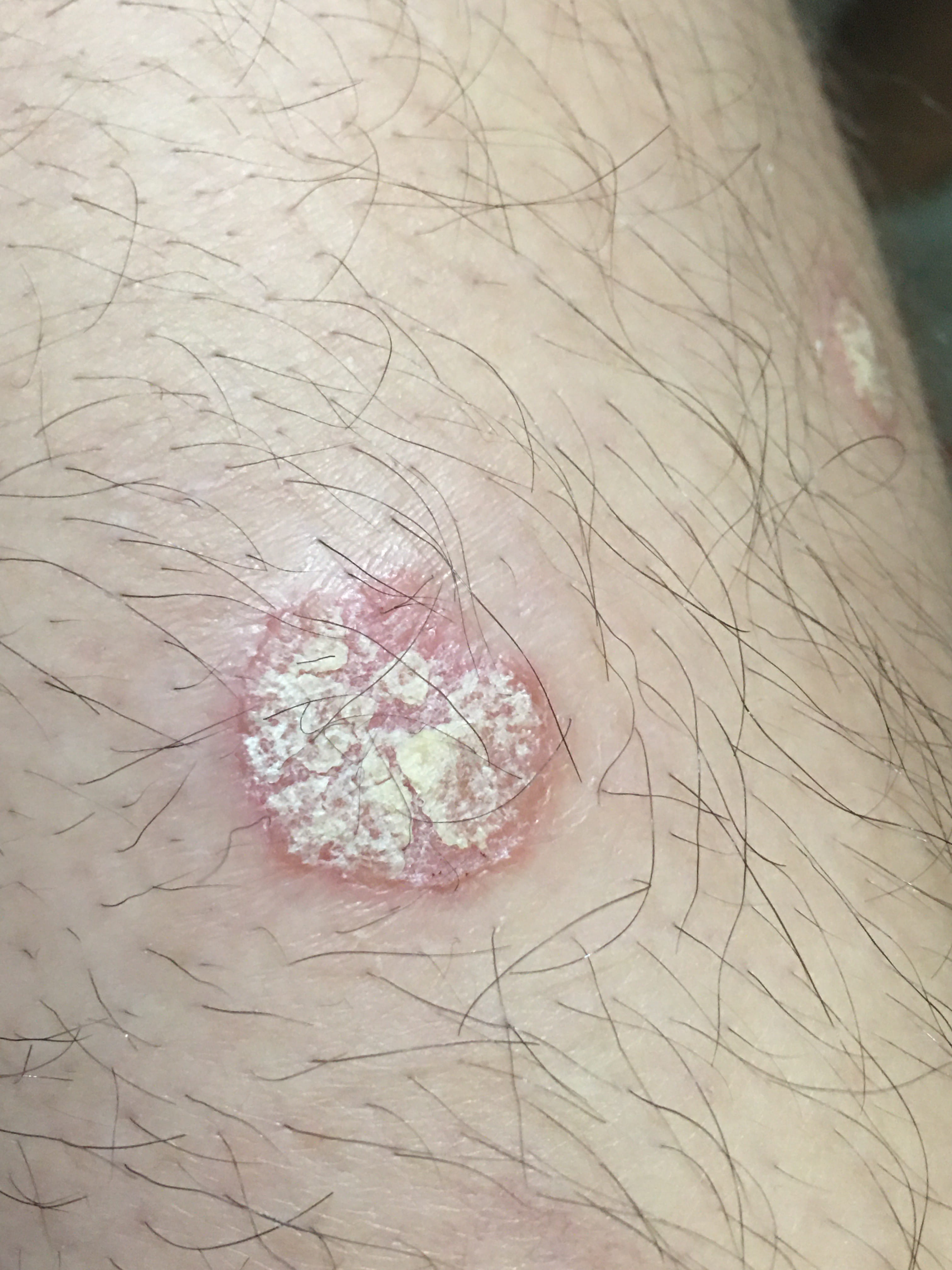 PSORIASIS