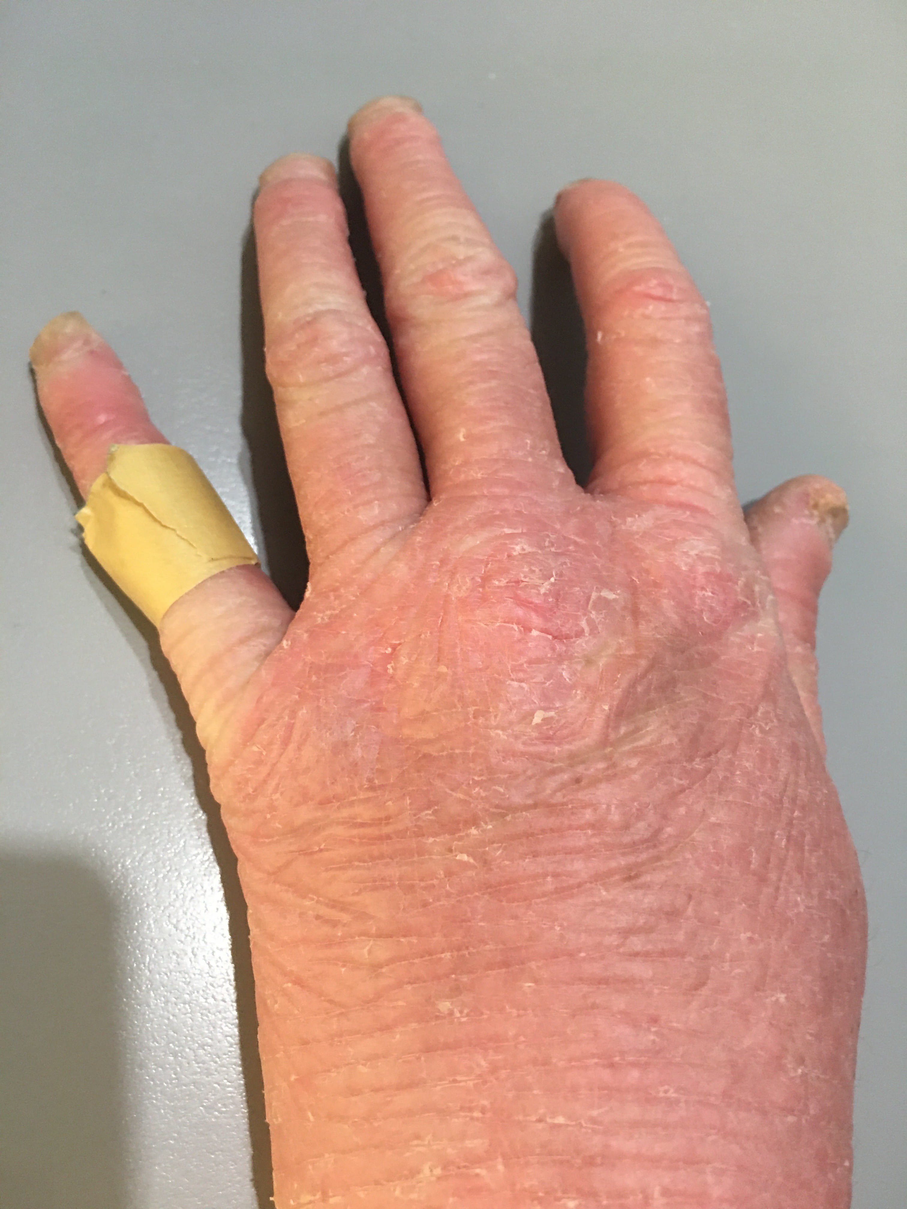 ERITRODERMIA PSORIATICA