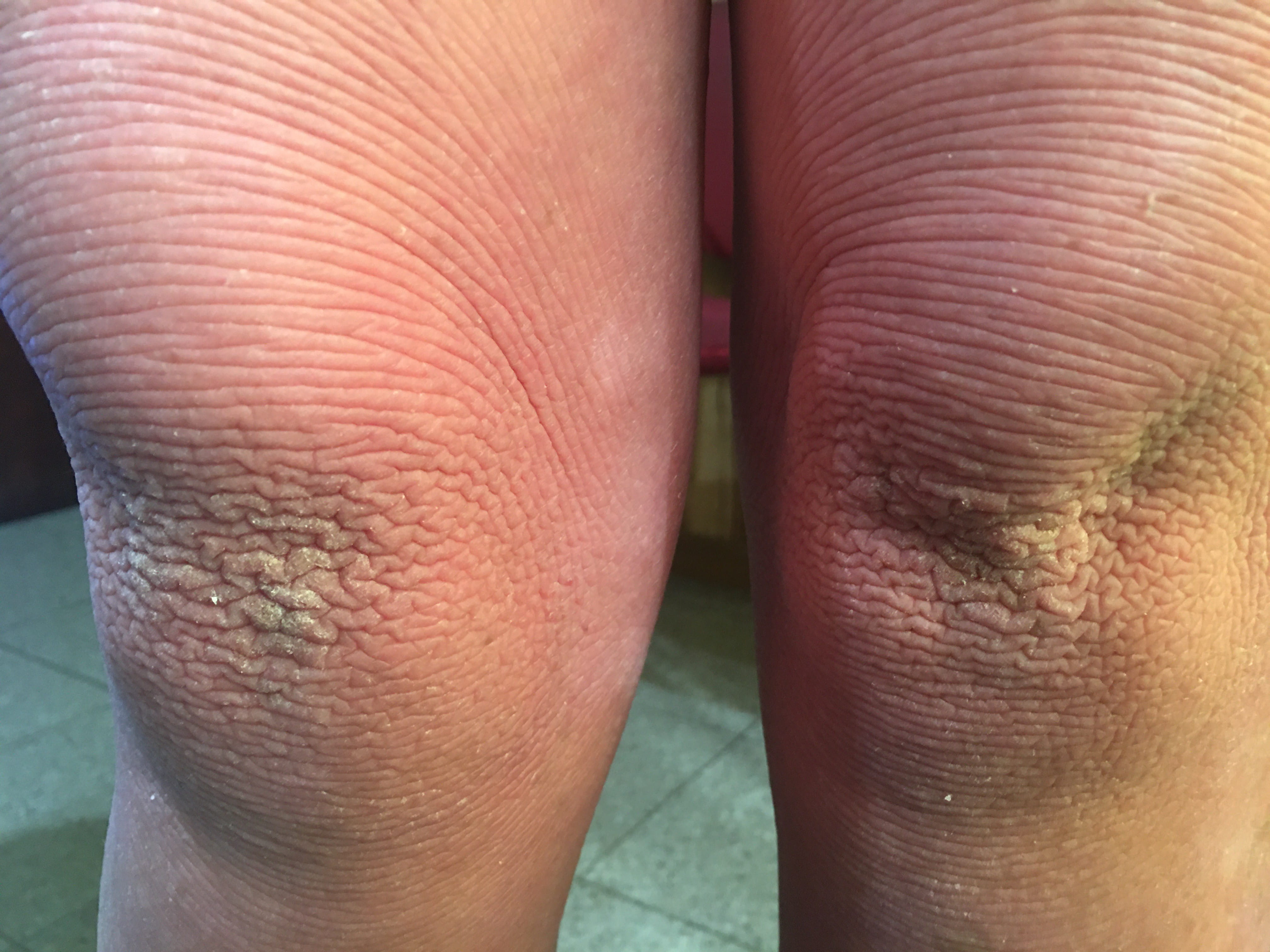 ERITRODERMIA PSORIATICA