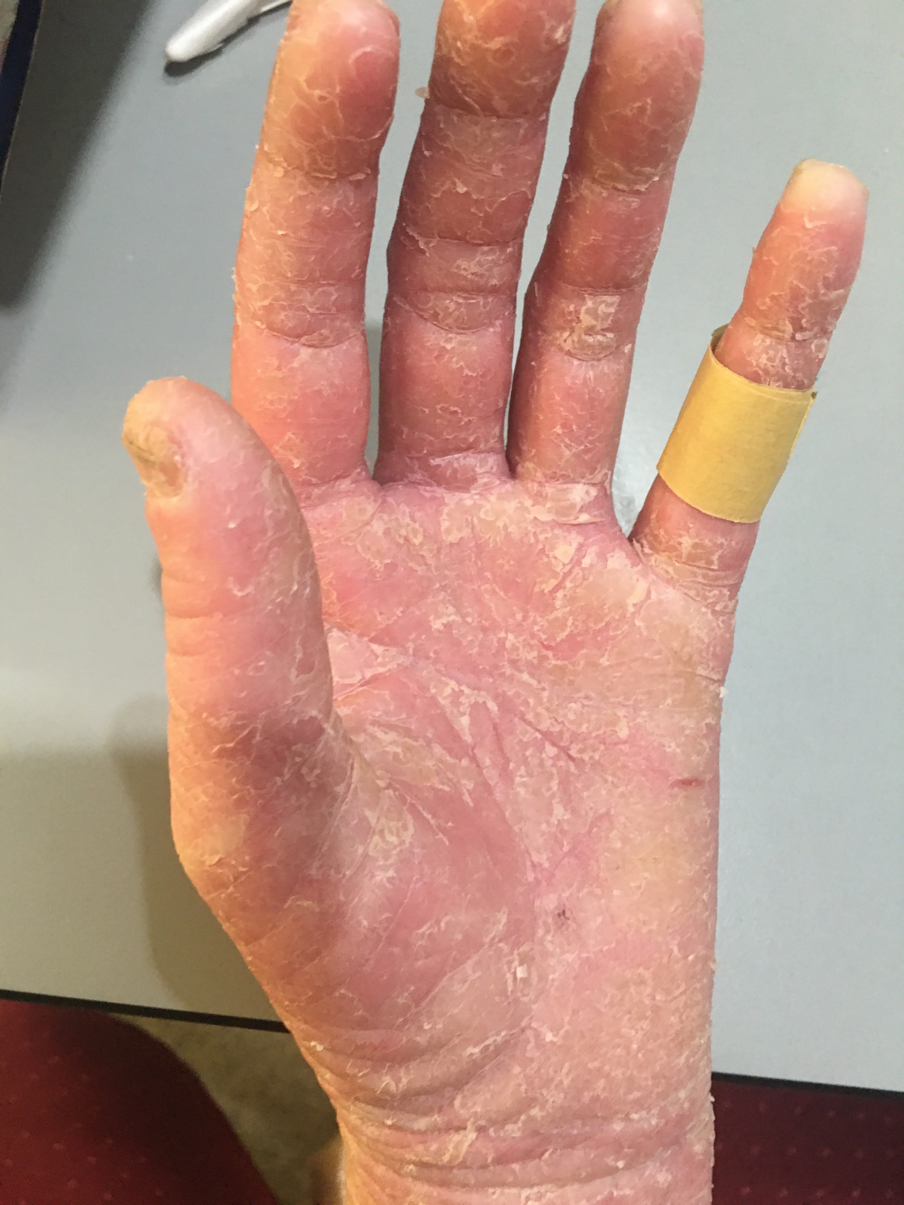 ERITRODERMIA PSORIATICA