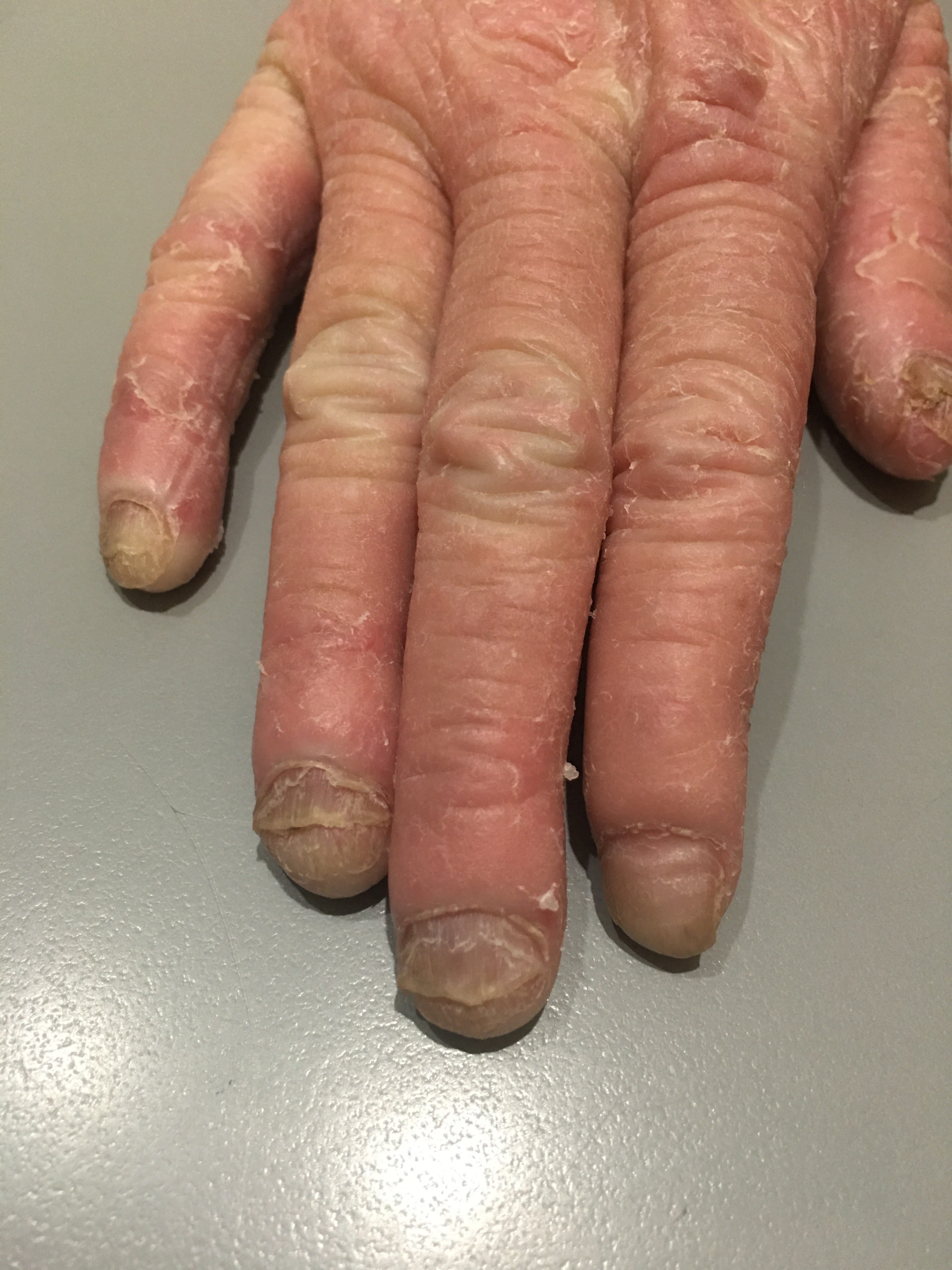 ERITRODERMIA PSORIATICA