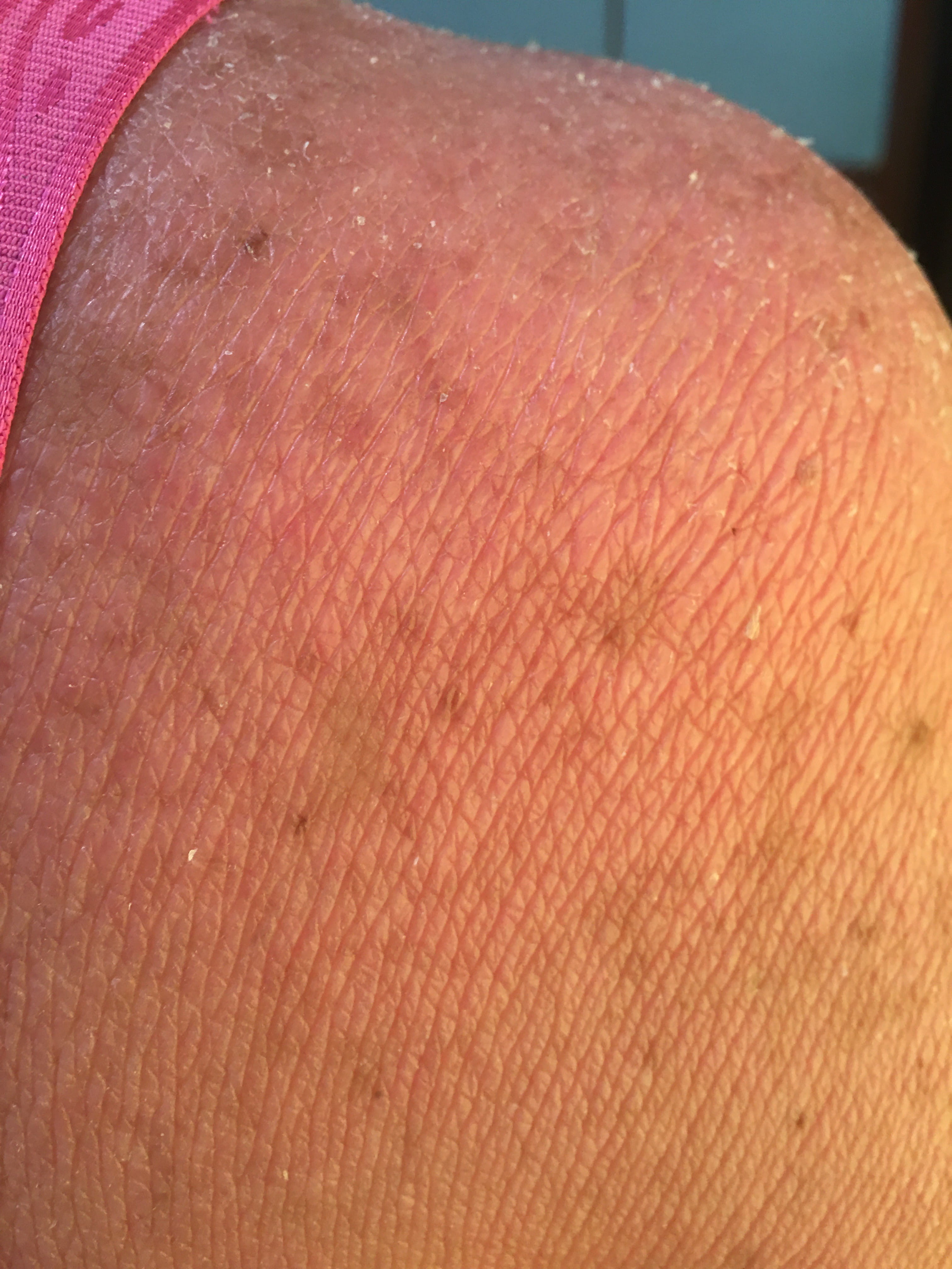 ERITRODERMIA PSORIATICA