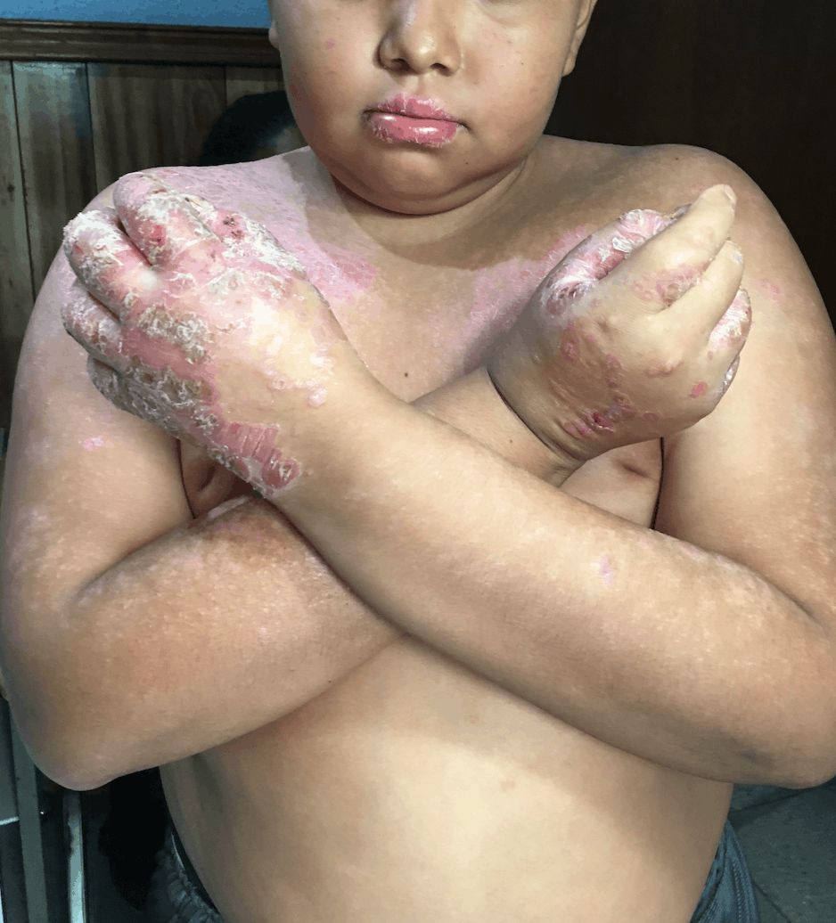 PSORIASIS EN NIÑOS