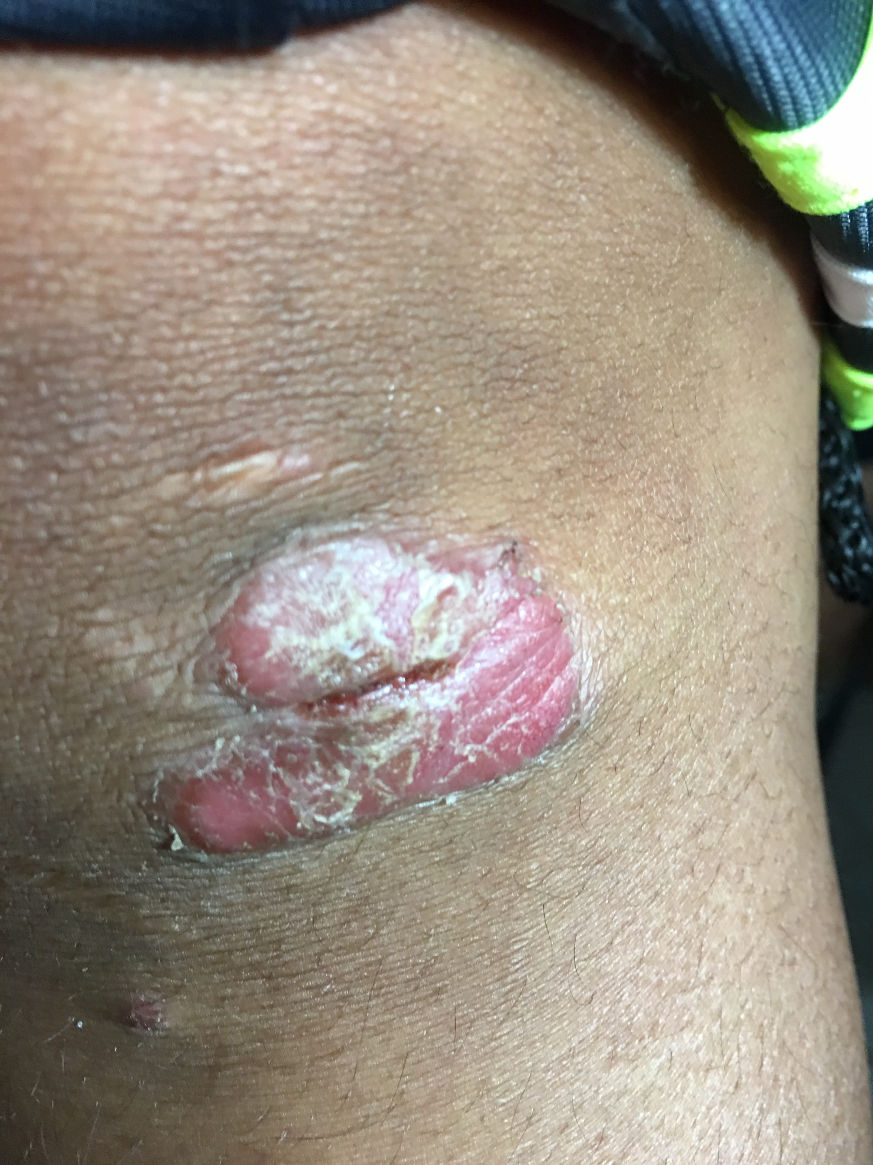 PSORIASIS EN NIÑOS