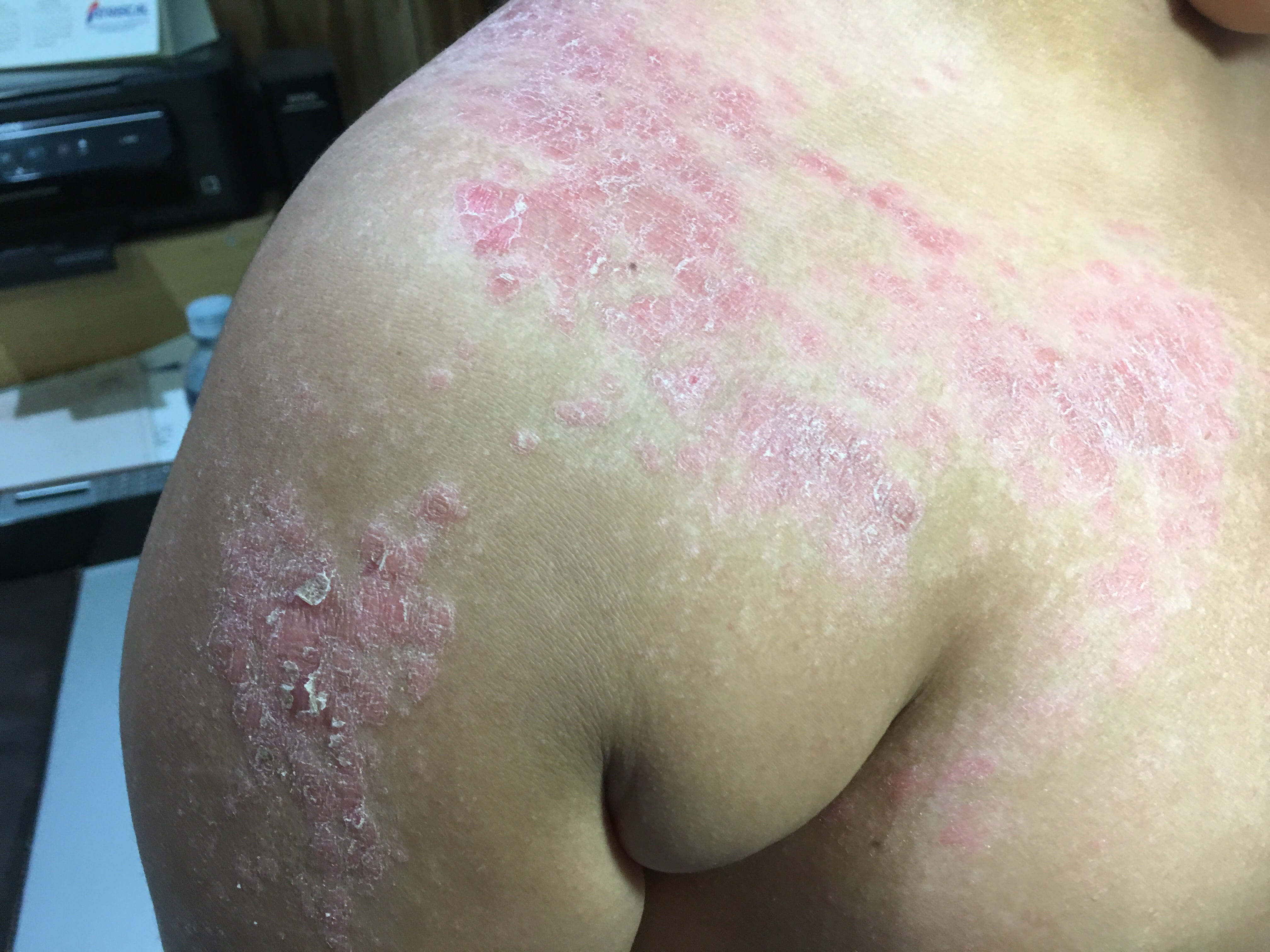 PSORIASIS EN NIÑOS