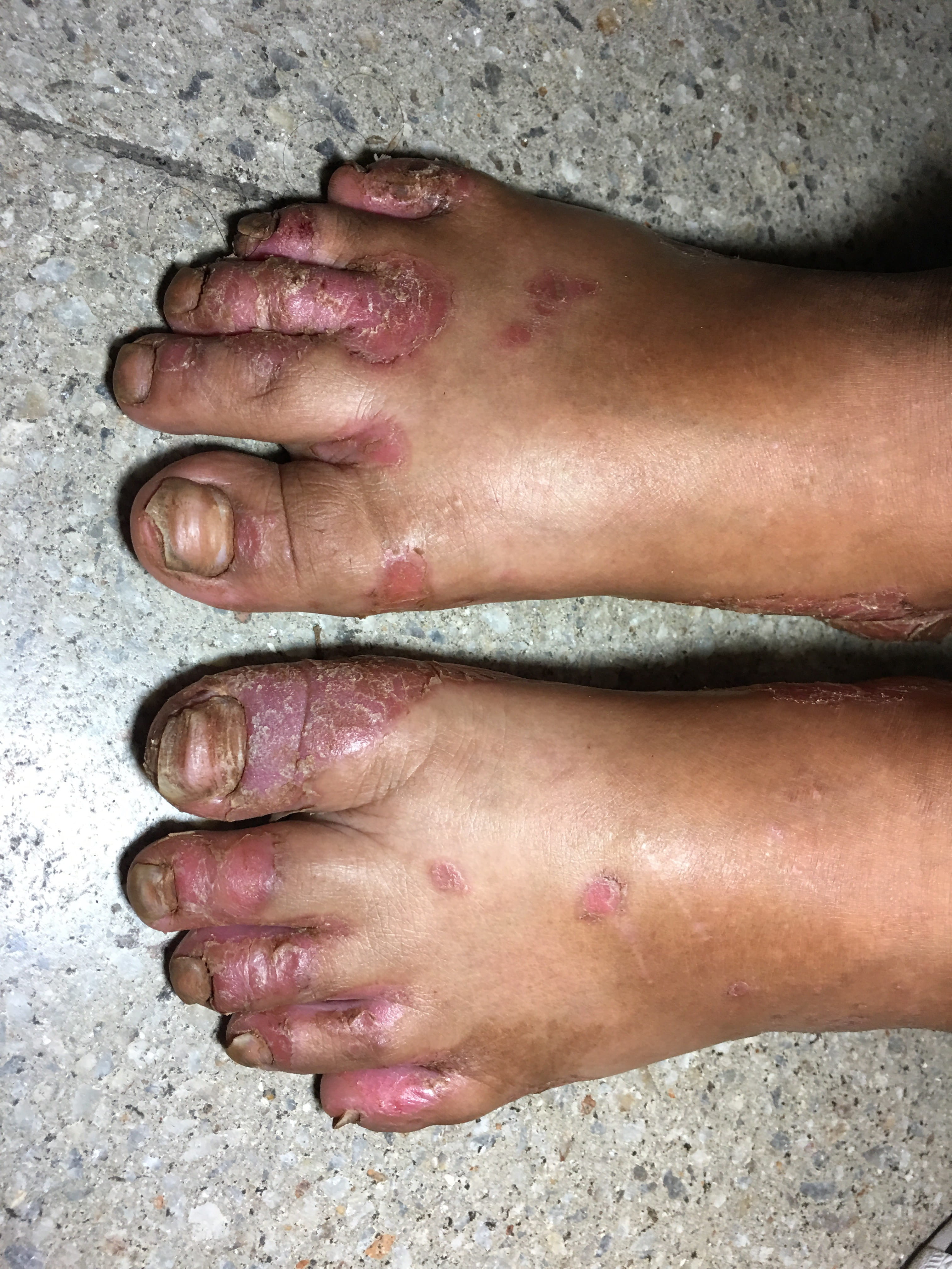 PSORIASIS EN NIÑOS