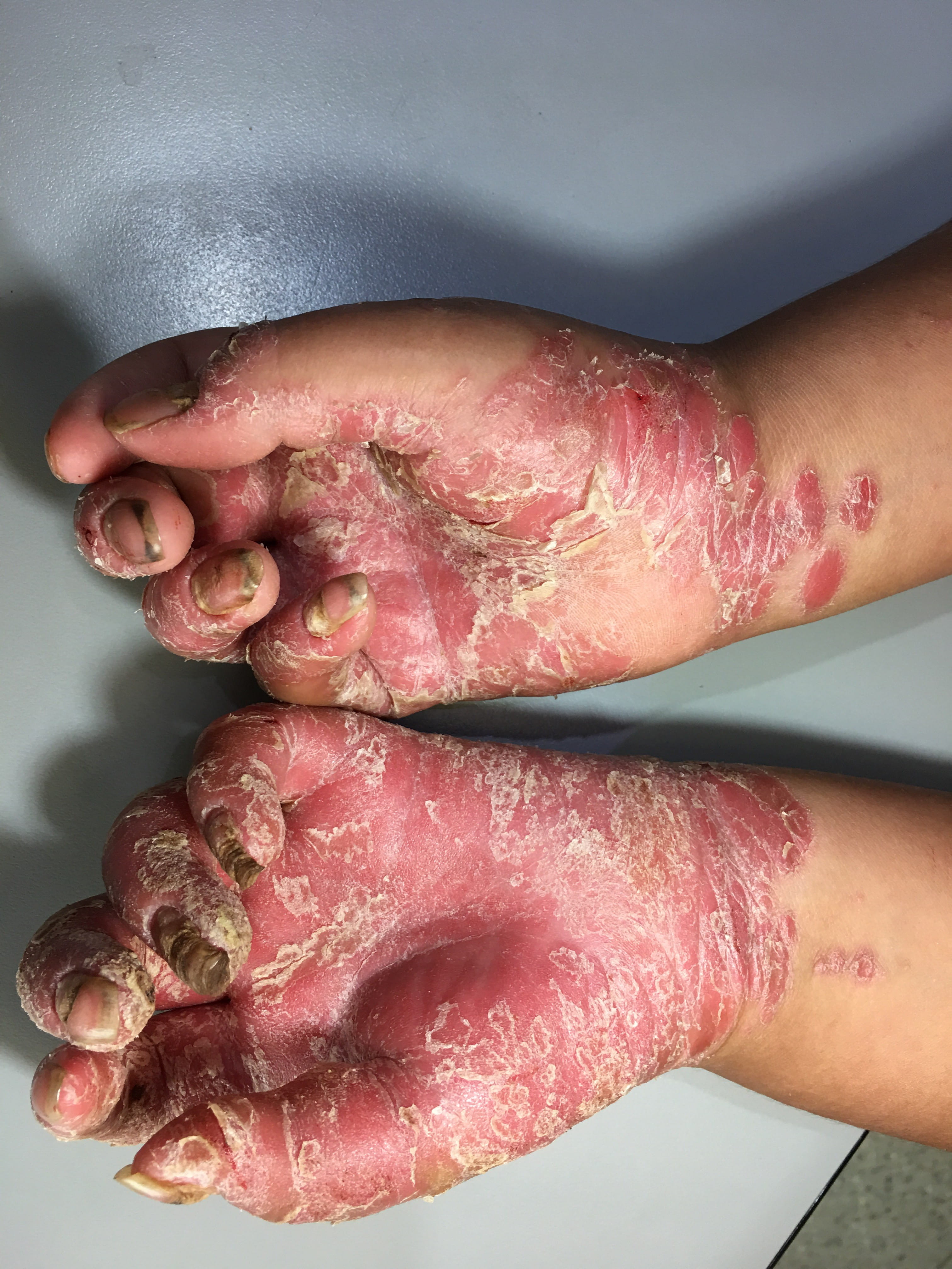 PSORIASIS EN NIÑOS