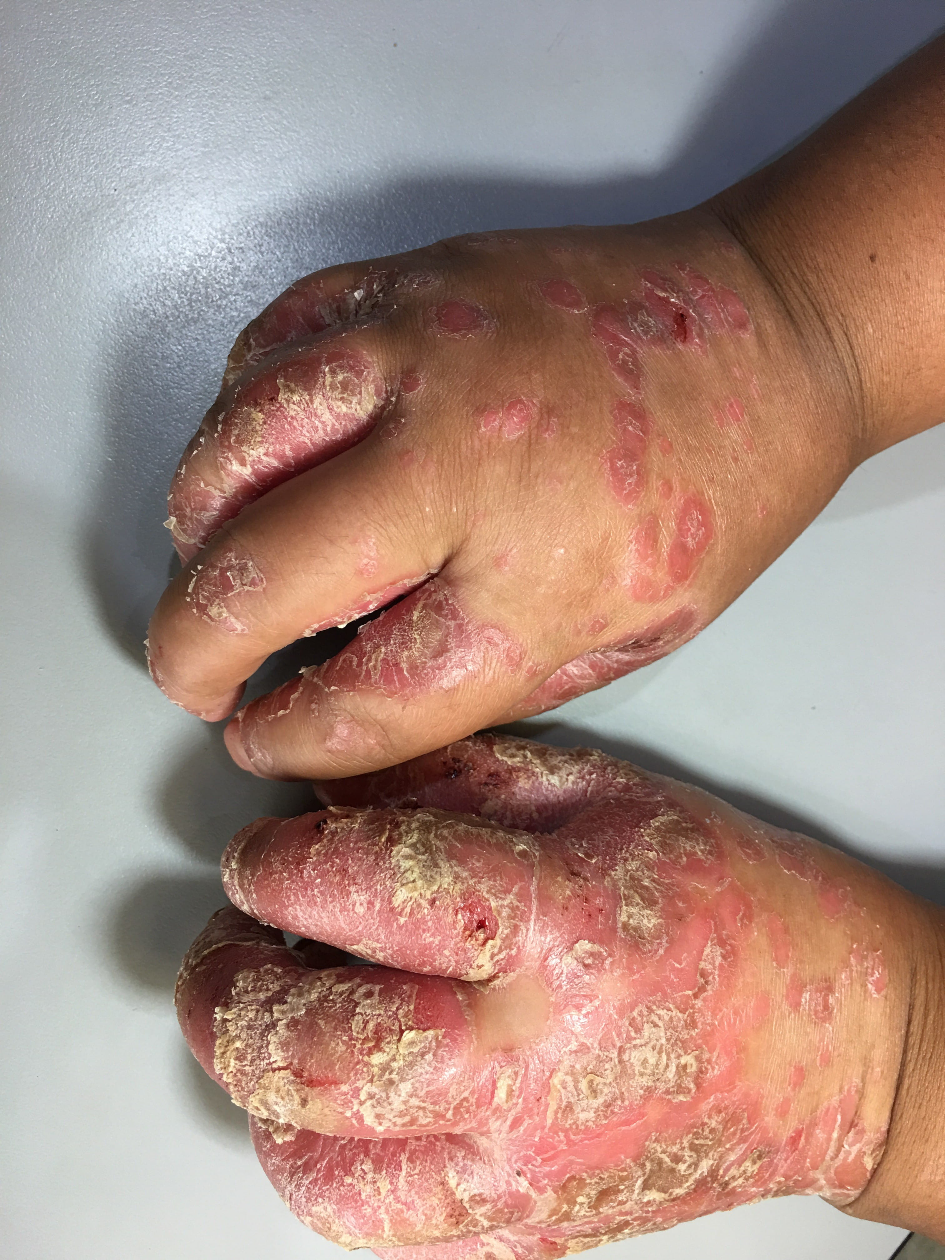 PSORIASIS EN NIÑOS