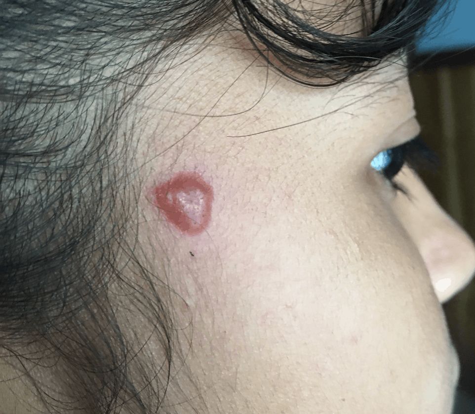 LISHMANIASIS CUTANEA