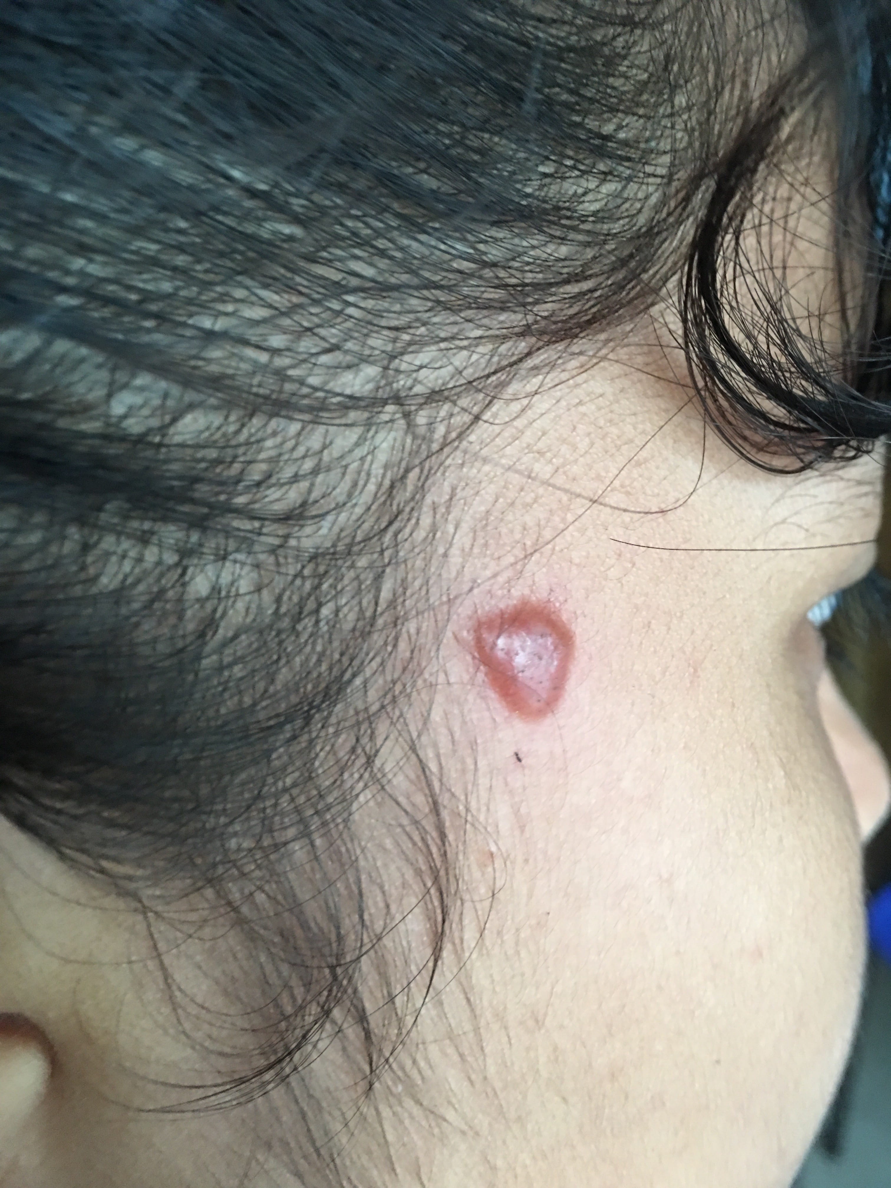LISHMANIASIS CUTANEA