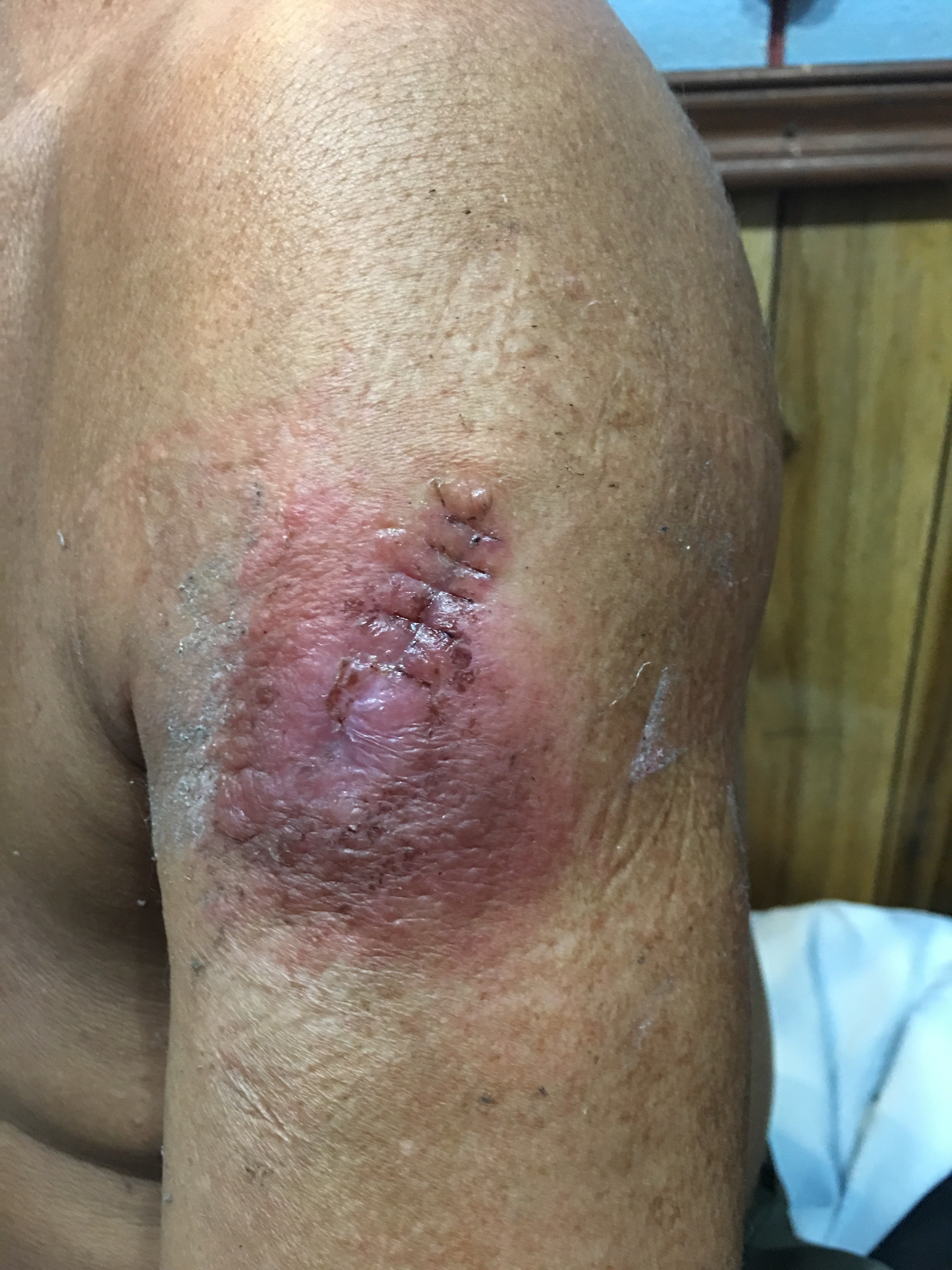 LISHMANIASIS CUTANEA