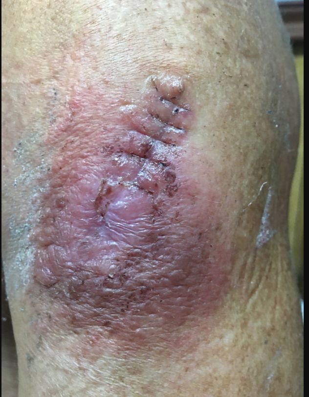 LISHMANIASIS CUTANEA
