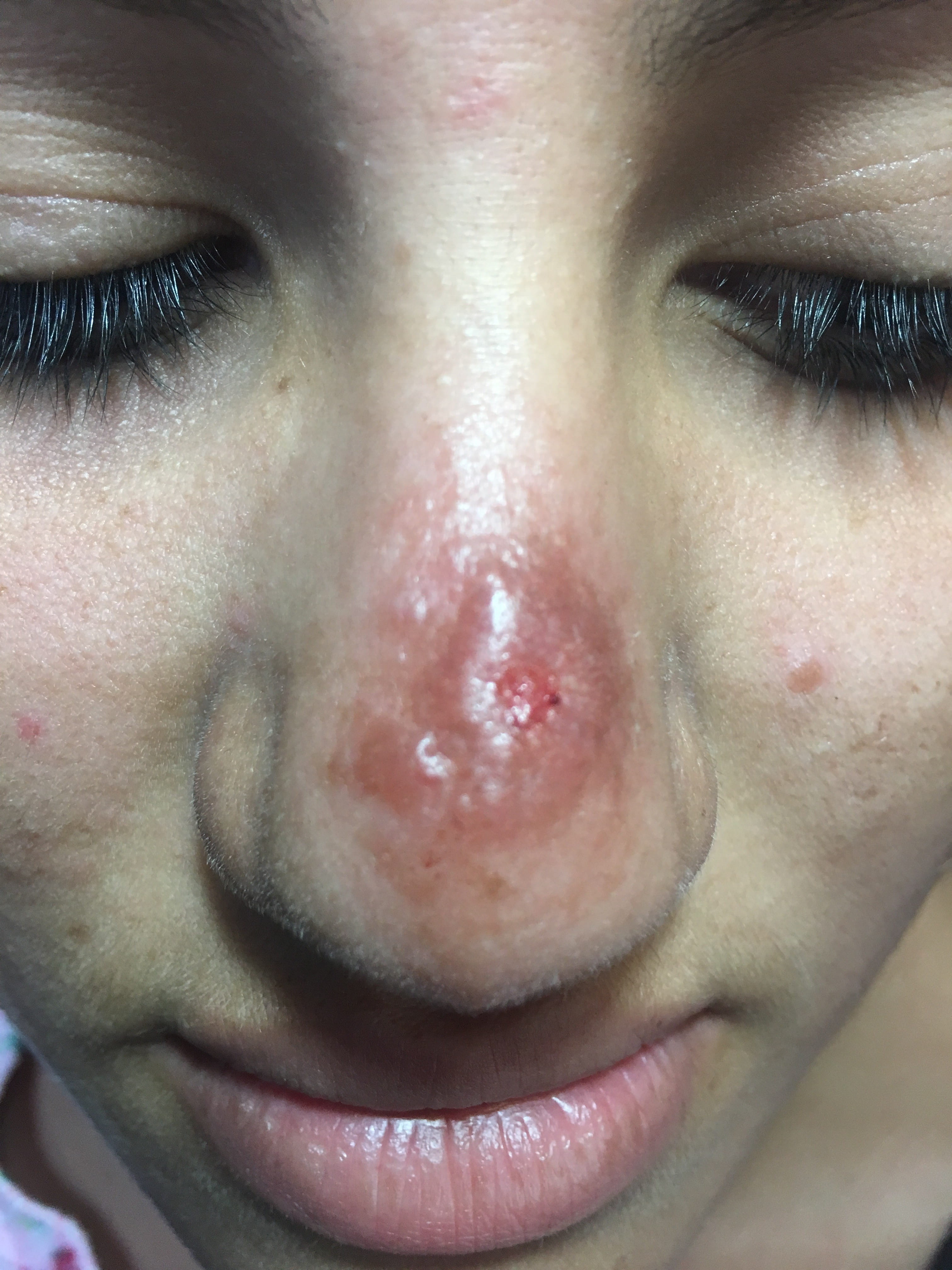 LISHMANIASIS CUTANEA