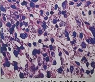 LISHMANIASIS CUTANEA - Histopatologia